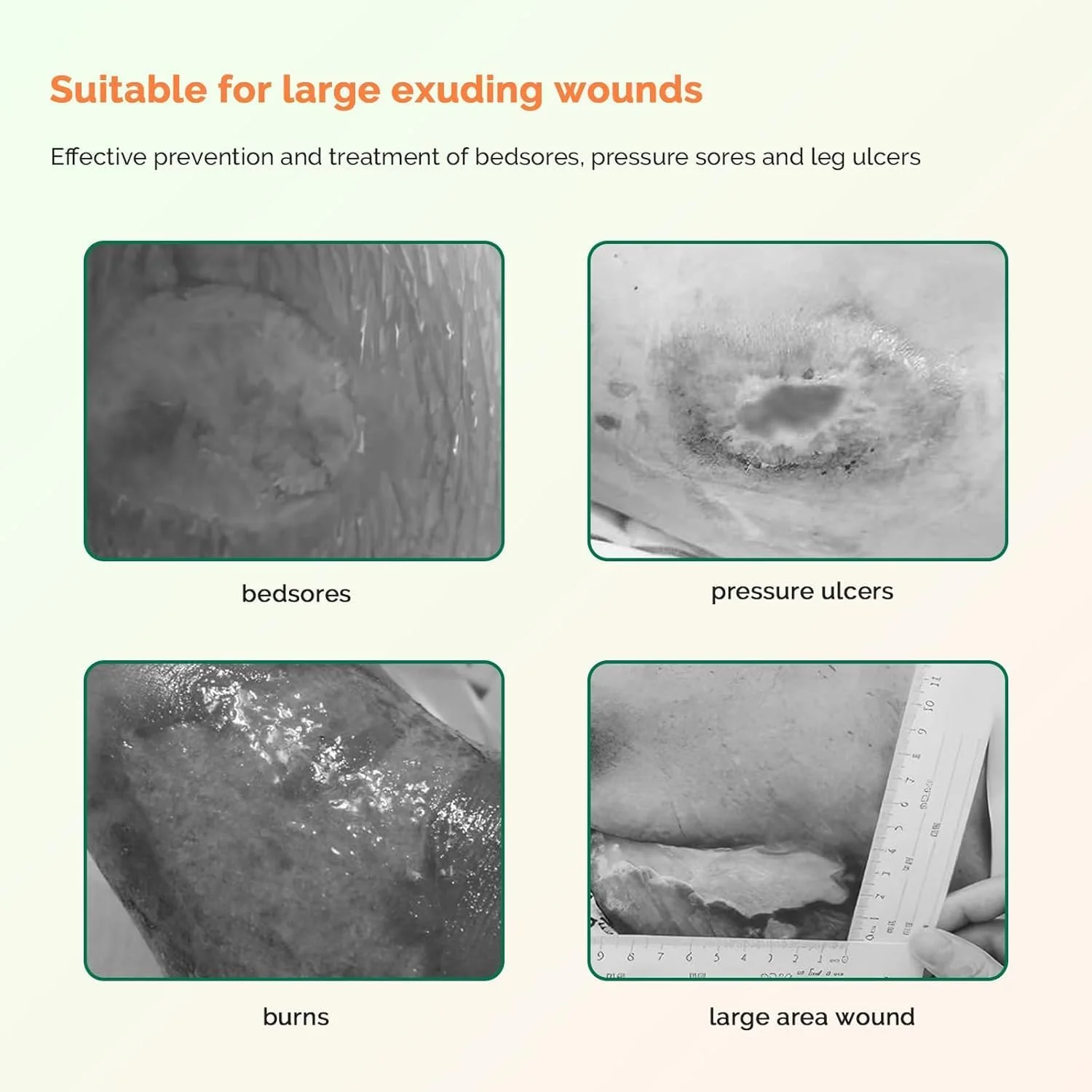 پانسمان فوم نقره ای ساکروم نالاکال با حاشیه چسب سیلیکونی 7"x7" ضد آب، پدهای استخوانی دنبالچه جاذب و تنفسی، پانسمان زخم بستر (5 عدد)