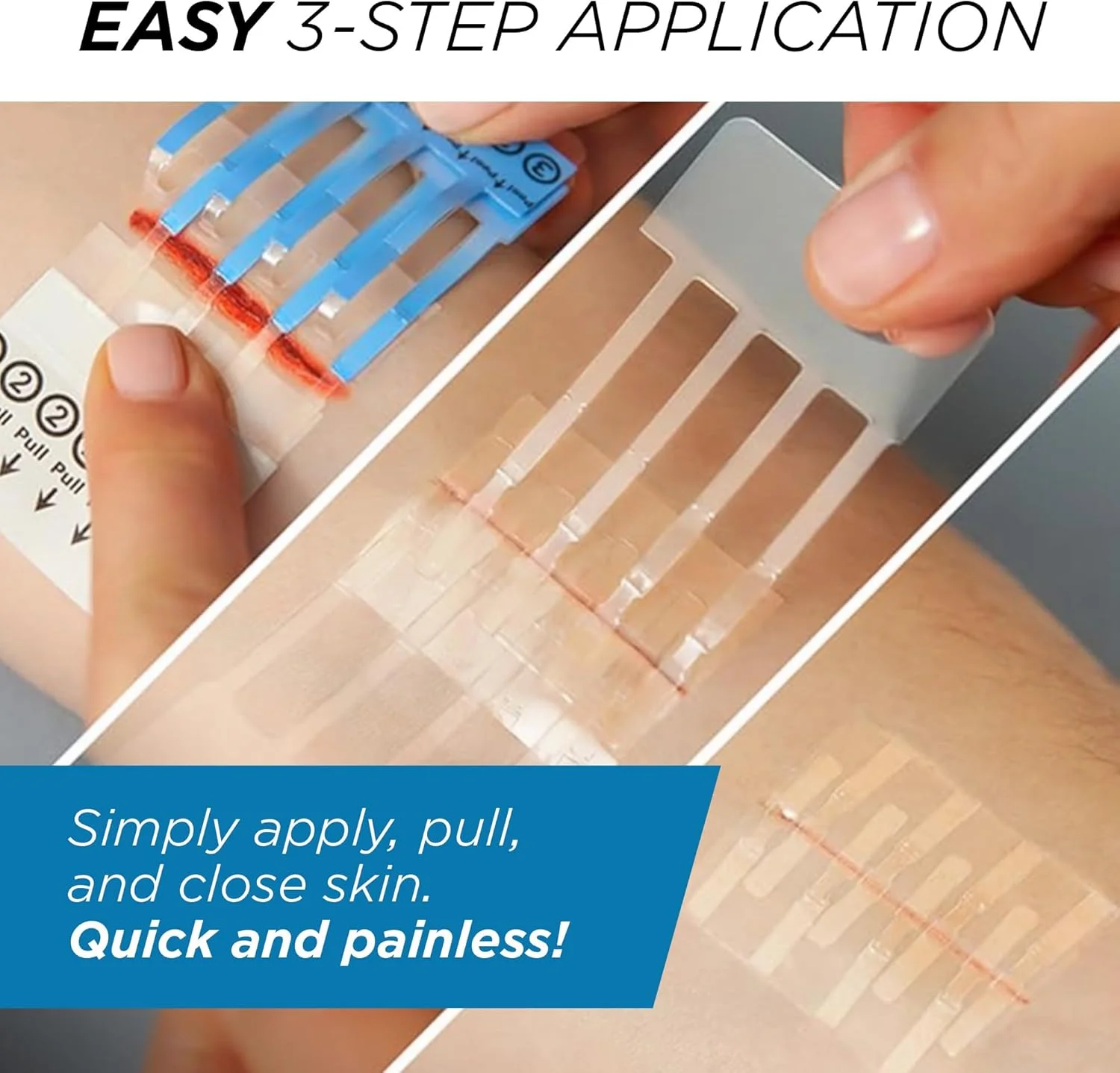 کیت کامل بخیه اضطراری Clozex - ترمیم زخم بدون نیاز به بخیه. دستگاه بستن پوست با مجوز FDA برای 2 زخم جداگانه یا ترکیب برای طول 2.5 اینچ کیت کامل بخیه اضطراری Clozex - ترمیم زخم بدون نیاز به بخیه. دستگاه بستن پوست با مجوز FDA برای 2 زخم جداگانه یا ترکیب برای طول 2.5 اینچ