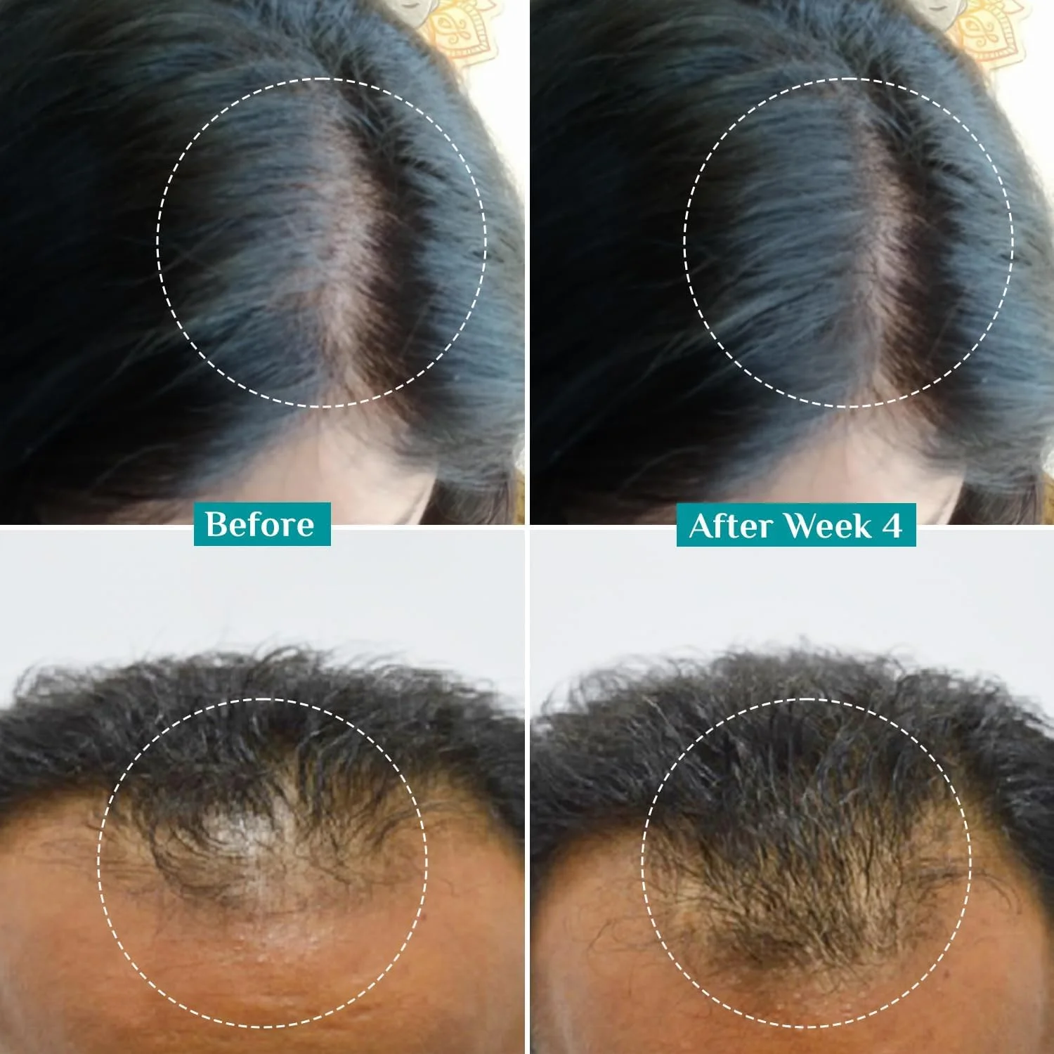 Pilgrim Redensyl 3% + Anagain 4% + Baicapil Advanced Hair Growth Serum (50ml) for Scalp with Korean Black Rice, Saw Palmetto | Control Hair Fall, Stimulate Hair Regrowth, Hair (50ml) Pilgrim Redensyl 3% + Anagain 4% + Baicapil Advanced Hair Growth Serum (50ml) for Scalp with Korean Black Rice, Saw Palmetto | Control Hair Fall, Stimulate Hair Regrowth, Hair (50ml)