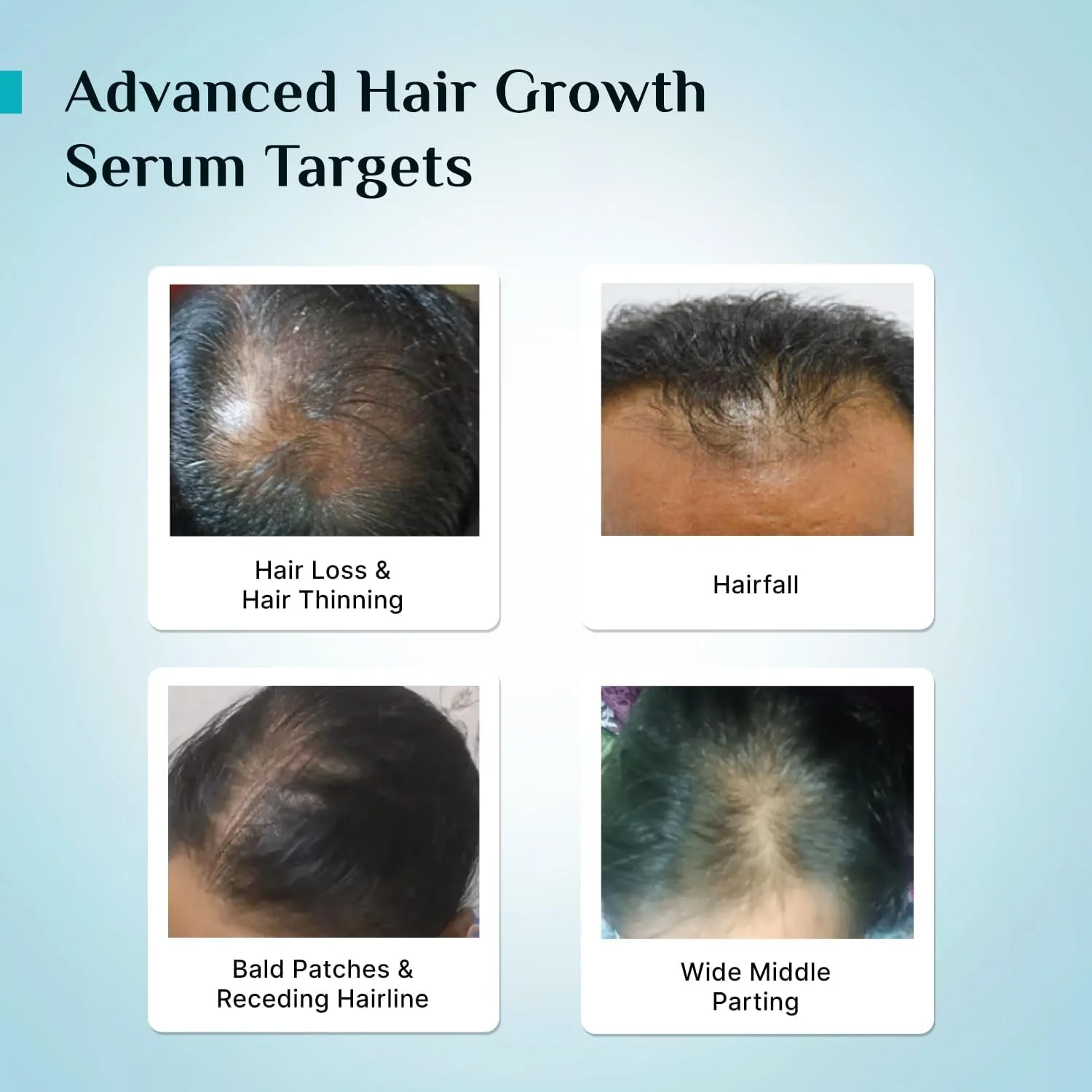 Pilgrim Redensyl 3% + Anagain 4% + Baicapil Advanced Hair Growth Serum (50ml) for Scalp with Korean Black Rice, Saw Palmetto | Control Hair Fall, Stimulate Hair Regrowth, Hair (50ml) Pilgrim Redensyl 3% + Anagain 4% + Baicapil Advanced Hair Growth Serum (50ml) for Scalp with Korean Black Rice, Saw Palmetto | Control Hair Fall, Stimulate Hair Regrowth, Hair (50ml)