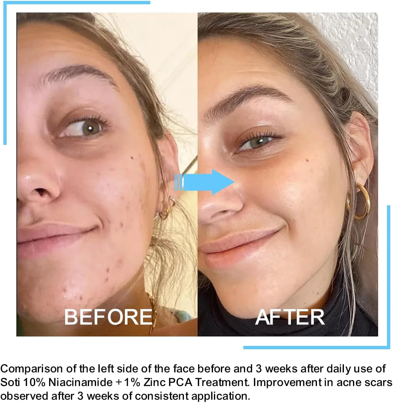 سرم صورت ساتی نیاسینامید 10% + زینک 1% حاوی B5 و هیالورونیک اسید | محو کننده جای جوش، کنترل کننده چربی، کوچک کننده منافذ، کاهش لک و قرمزی، پشتیبانی از پوست شفاف (30 میلی لیتر) سرم صورت ساتی نیاسینامید 10% + زینک 1% حاوی B5 و هیالورونیک اسید | محو کننده جای جوش، کنترل کننده چربی، کوچک کننده منافذ، کاهش لک و قرمزی، پشتیبانی از پوست شفاف (30 میلی لیتر)