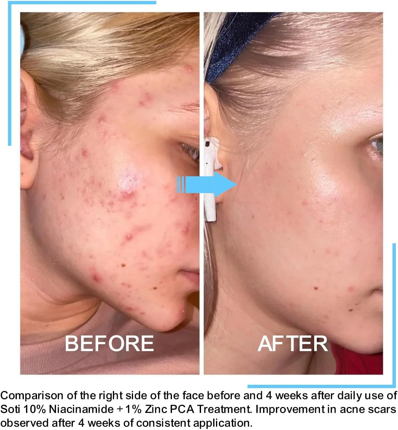 سرم صورت ساتی نیاسینامید 10% + زینک 1% حاوی B5 و هیالورونیک اسید | محو کننده جای جوش، کنترل کننده چربی، کوچک کننده منافذ، کاهش لک و قرمزی، پشتیبانی از پوست شفاف (30 میلی لیتر) سرم صورت ساتی نیاسینامید 10% + زینک 1% حاوی B5 و هیالورونیک اسید | محو کننده جای جوش، کنترل کننده چربی، کوچک کننده منافذ، کاهش لک و قرمزی، پشتیبانی از پوست شفاف (30 میلی لیتر)