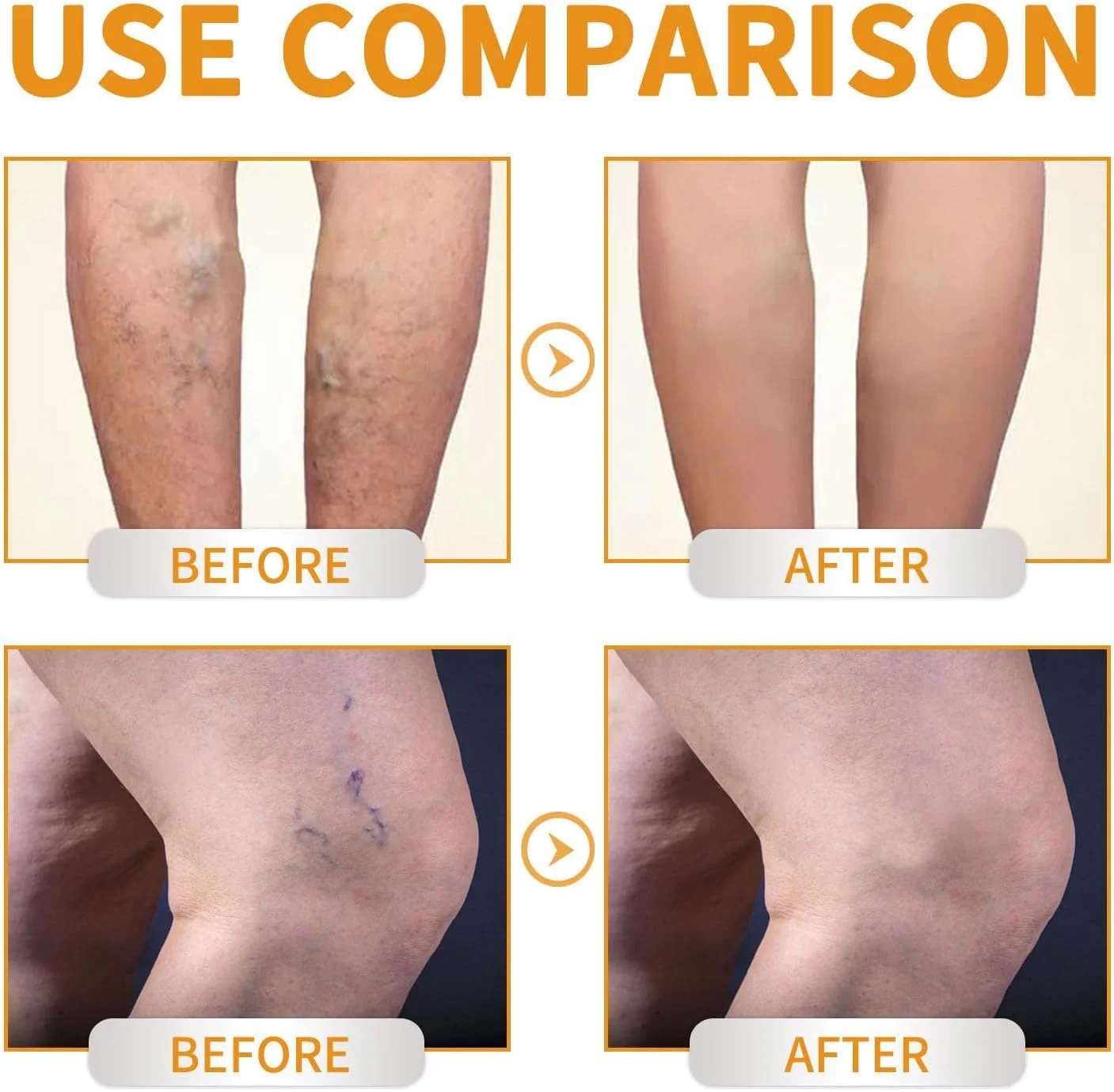 کرم معجزه آسای رگ های واریسی حاوی ویتامین K، درمان تسکین دهنده رگ ها برای پاها و صورت، کاهش دهنده ظاهر رگ های واریسی و عنکبوتی، صاف کننده پوست (2 عدد) کرم معجزه آسای رگ های واریسی حاوی ویتامین K، درمان تسکین دهنده رگ ها برای پاها و صورت، کاهش دهنده ظاهر رگ های واریسی و عنکبوتی، صاف کننده پوست (2 عدد)