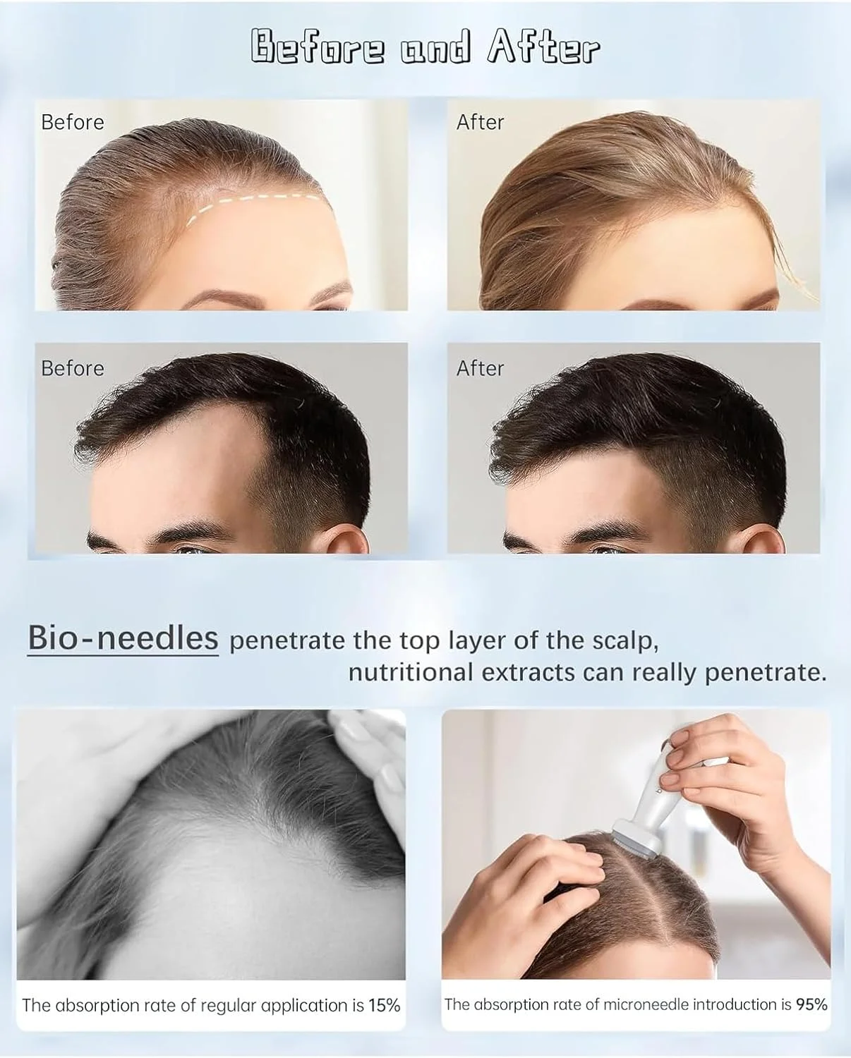 میکرونیدلینگ درما استمپ قابل تنظیم 0-2 میلی‌متر 120 سوزنه برای مو، رشد ریش، کوچک کردن منافذ، روشن کردن رنگ پوست