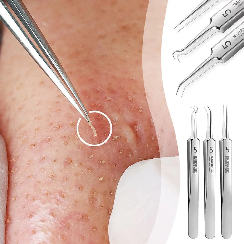 ست 3 عددی موچین جوش سرسیاه حرفه ای، موچین های حذف کننده جوش سرسیاه صورت، ابزار دقیق استخراج کننده، کیت حذف آکنه، ابزار بیرون آوردن جوش با جعبه نگهداری ست 3 عددی موچین جوش سرسیاه حرفه ای، موچین های حذف کننده جوش سرسیاه صورت، ابزار دقیق استخراج کننده، کیت حذف آکنه، ابزار بیرون آوردن جوش با جعبه نگهداری