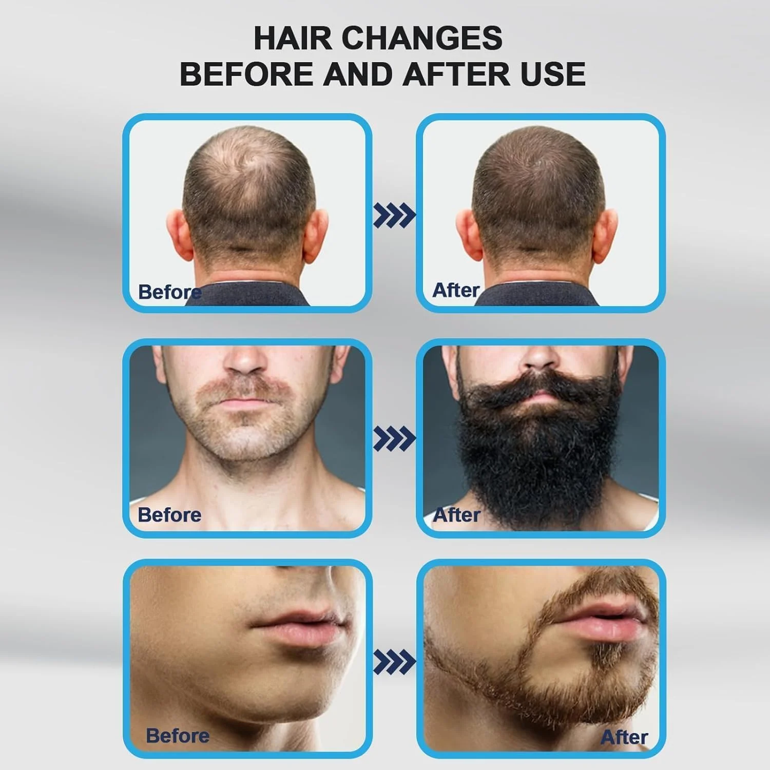 میکرونیدلینگ درما استمپ تیتانیومی قابل تنظیم 140 سوزنه Stolenband® - درما میکرونیدل استمپ برای صورت، مو، ریش و پوست سر - جایگزین درمارولر برای مراقبت از پوست - درما استمپ برای استفاده خانگی (مو و ریش) میکرونیدلینگ درما استمپ تیتانیومی قابل تنظیم 140 سوزنه Stolenband® - درما میکرونیدل استمپ برای صورت، مو، ریش و پوست سر - جایگزین درمارولر برای مراقبت از پوست - درما استمپ برای استفاده خانگی (مو و ریش)