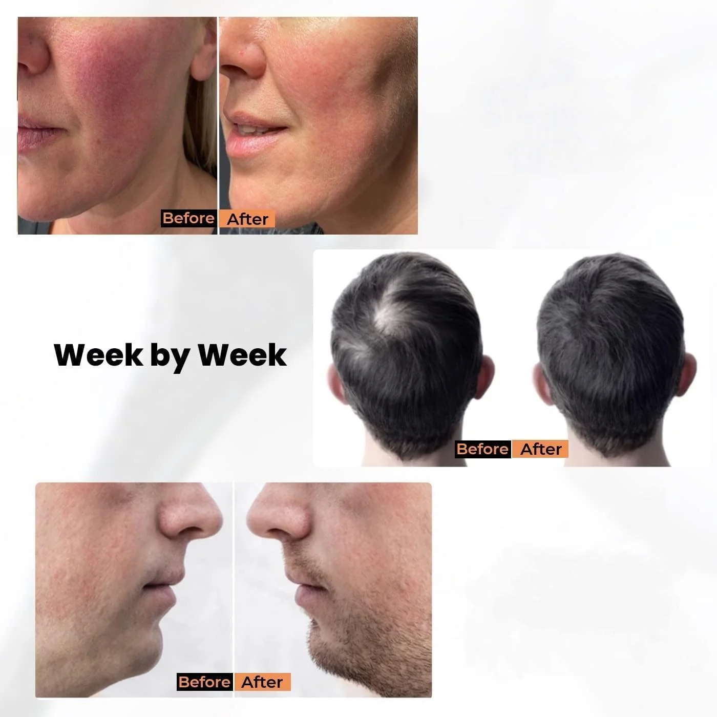 میکرونیدلینگ درما استمپ R A Products، جایگزین درما رولر، قلم میکرونیدلینگ قابل استفاده مجدد با پوشش سوزن، ابزار مراقبت از پوست برای صورت، بدن، رشد مو و ریش