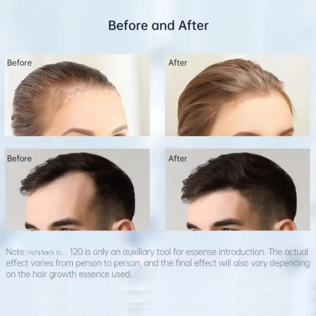 میکرونیدلینگ درما استمپ NIKITA.VIVI، دارای 120 سوزن قابل تنظیم 0-2 میلیمتری، قلم میکرونیدلینگ حرفهای استیل ضد زنگ برای زنان و مردان، مناسب برای رشد مو، مراقبت از پوست و رشد ریش میکرونیدلینگ درما استمپ NIKITA.VIVI، دارای 120 سوزن قابل تنظیم 0-2 میلیمتری، قلم میکرونیدلینگ حرفهای استیل ضد زنگ برای زنان و مردان، مناسب برای رشد مو، مراقبت از پوست و رشد ریش