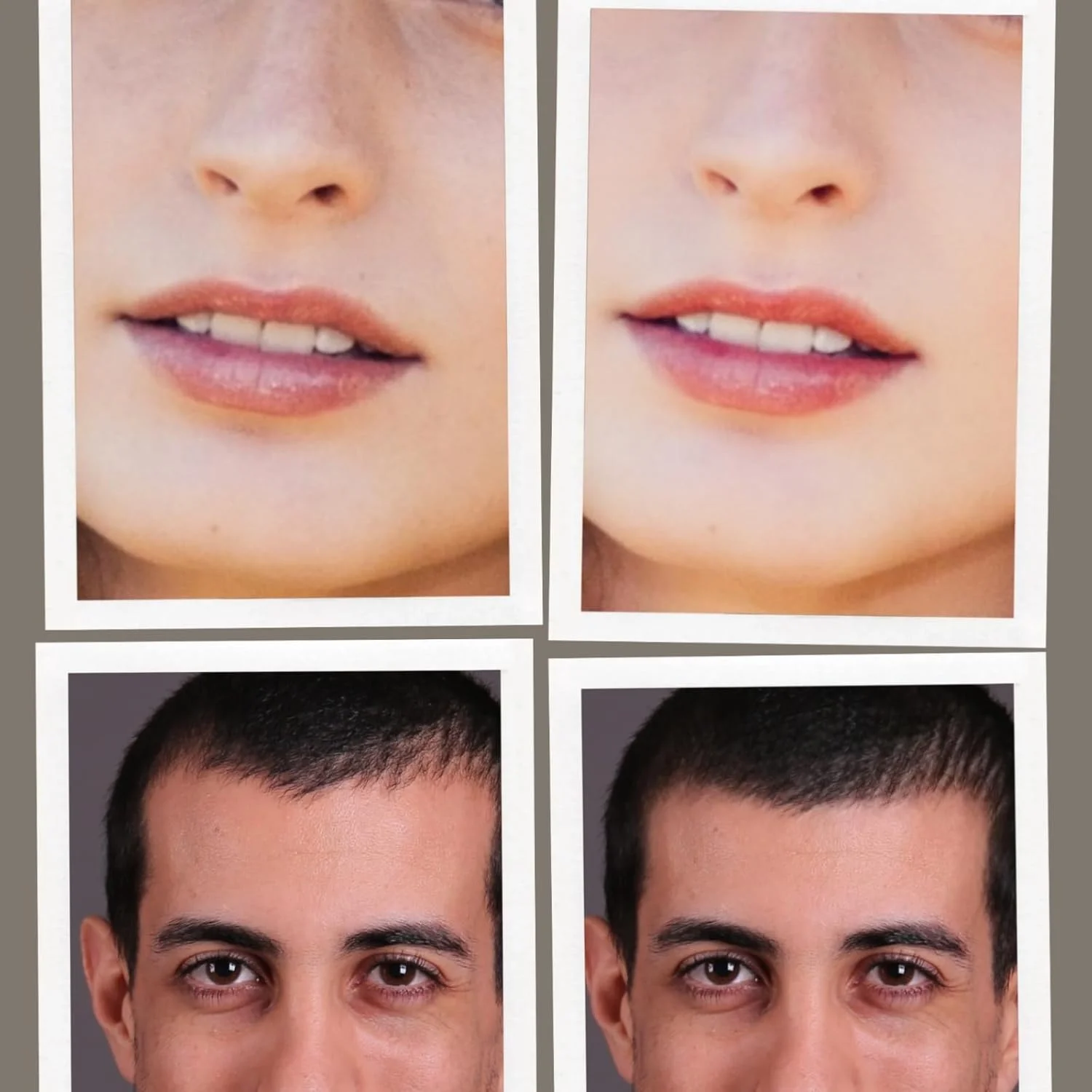 قلم میکرونیدل درمارولر - قلم زیبایی میکرونیدلینگ حرفه ای 0.25 میلی متری درمارولر - قلم رولر میکرونیدل برای ابزار مردان و زنان