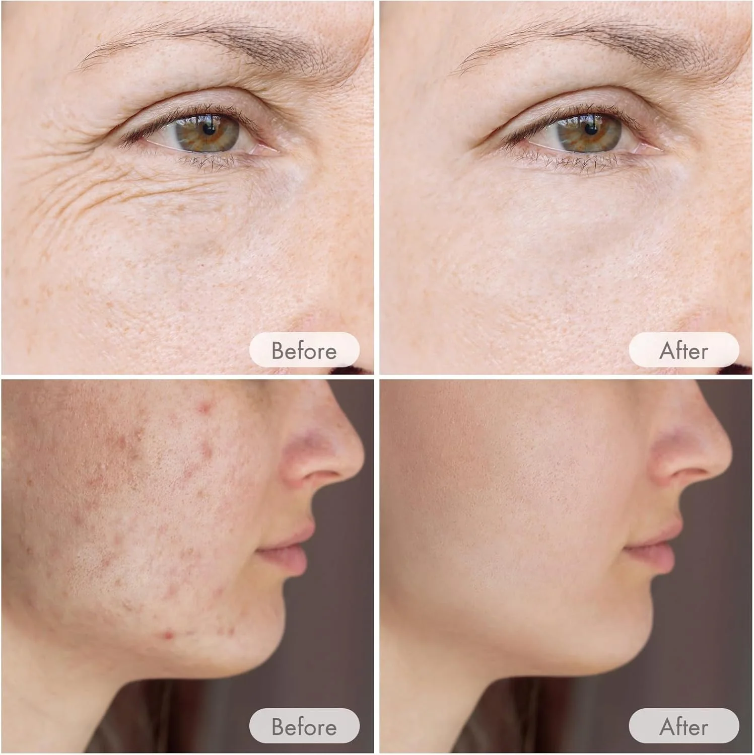 قلم میکرونیدلینگ بی سیم حرفه ای Excefore، میکرونیدلینگ بی سیم سرم اتوماتیک با کارتریج های 12 پین، 6 سطح سرعت 0-1.0 میلی متر میکرونیدلینگ قابل تنظیم، کیت قلم زیبایی حرفه ای خانگی