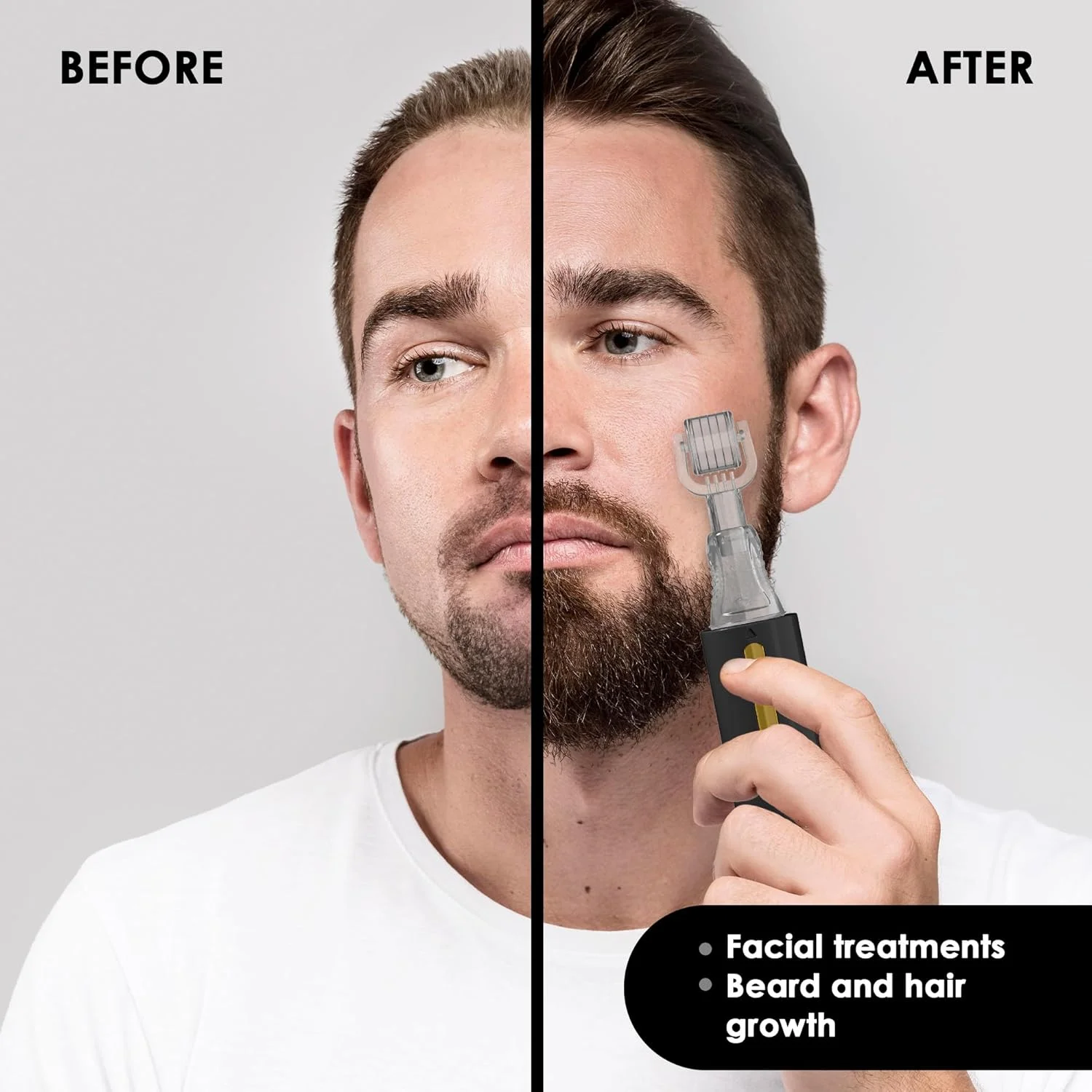 درمارولر 0.25 میلیمتری با مخزن برای مو، ریش، پوست، لب، چین و چروک، ترکهای پوستی، هایپرپیگمنتیشن، استفاده فوری از سرم، 105 سوزن تیتانیومی درمارولر 0.25 میلیمتری با مخزن برای مو، ریش، پوست، لب، چین و چروک، ترکهای پوستی، هایپرپیگمنتیشن، استفاده فوری از سرم، 105 سوزن تیتانیومی