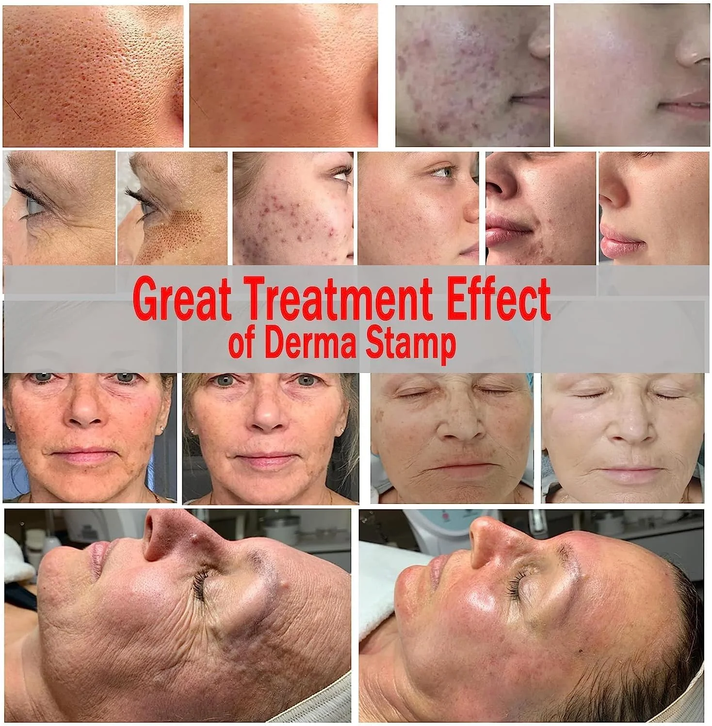 میکرونیدلینگ درما استمپ اورجینال جنریک - درماپن میکرونیدلینگ قابل تنظیم حرفه ای برای رشد مو و ریش - قلم شگفت انگیز پوست برای صورت - 140 سوزن تیتانیومی - بهترین جایگزین درمارولر میکرونیدلینگ درما استمپ اورجینال جنریک - درماپن میکرونیدلینگ قابل تنظیم حرفه ای برای رشد مو و ریش - قلم شگفت انگیز پوست برای صورت - 140 سوزن تیتانیومی - بهترین جایگزین درمارولر