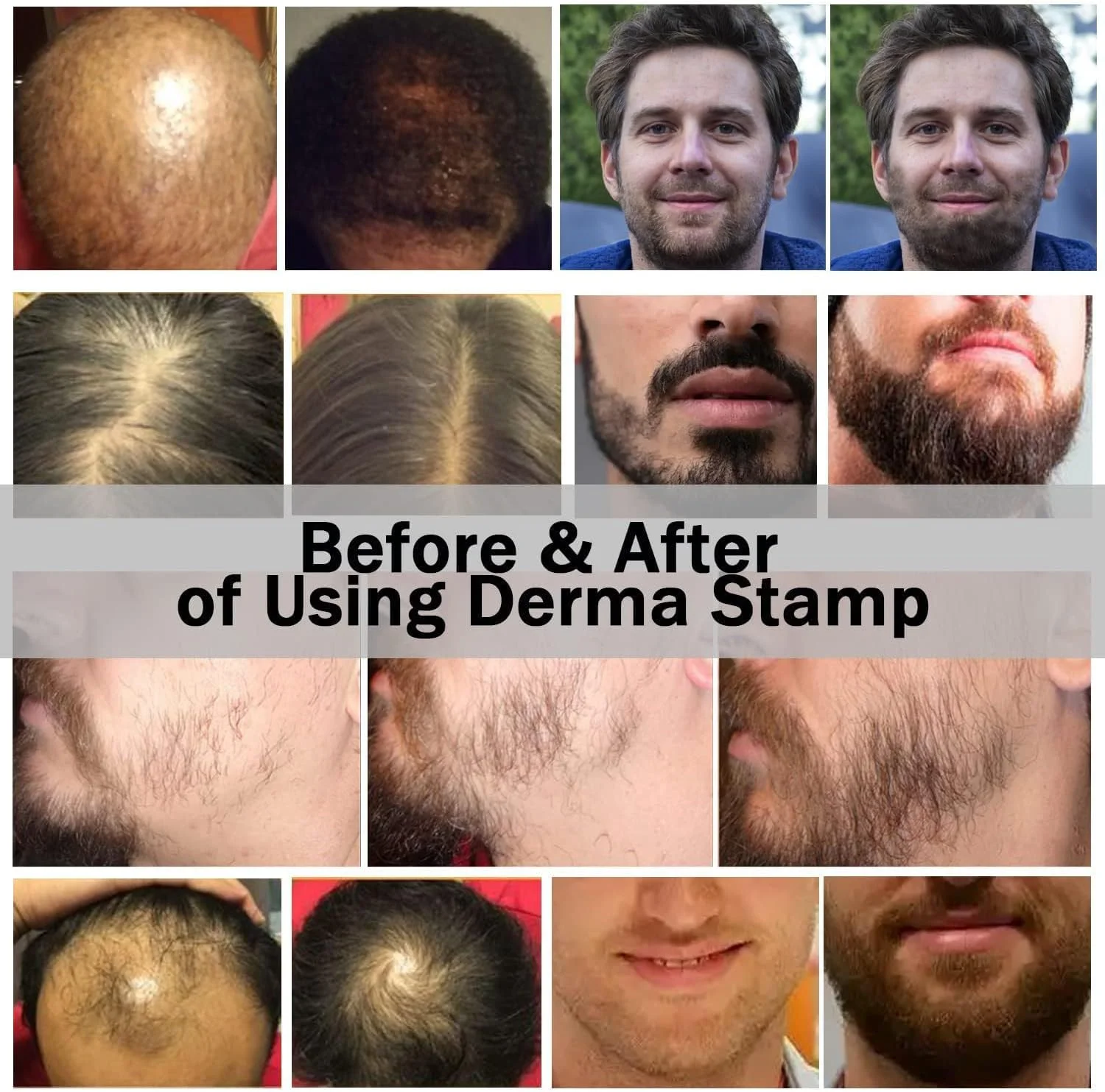 میکرونیدلینگ درما استمپ اورجینال جنریک - درماپن میکرونیدلینگ قابل تنظیم حرفه ای برای رشد مو و ریش - قلم شگفت انگیز پوست برای صورت - 140 سوزن تیتانیومی - بهترین جایگزین درمارولر میکرونیدلینگ درما استمپ اورجینال جنریک - درماپن میکرونیدلینگ قابل تنظیم حرفه ای برای رشد مو و ریش - قلم شگفت انگیز پوست برای صورت - 140 سوزن تیتانیومی - بهترین جایگزین درمارولر