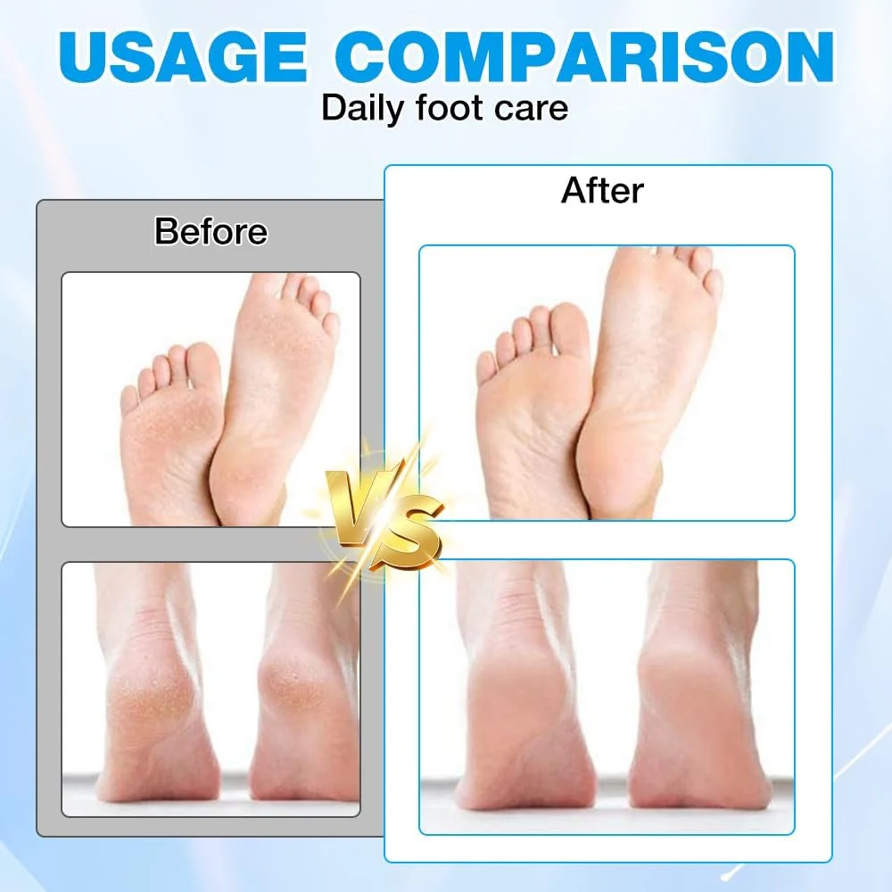 سوهان برقی پدیکور پا، سوهان برقی از بین برنده پینه پا با کابل شارژ USB، دستگاه برقی مراقبت از پا برای پوست های مرده، ست پدیکور قوی، مناسب پوست های سخت و ترک خورده (آبی)