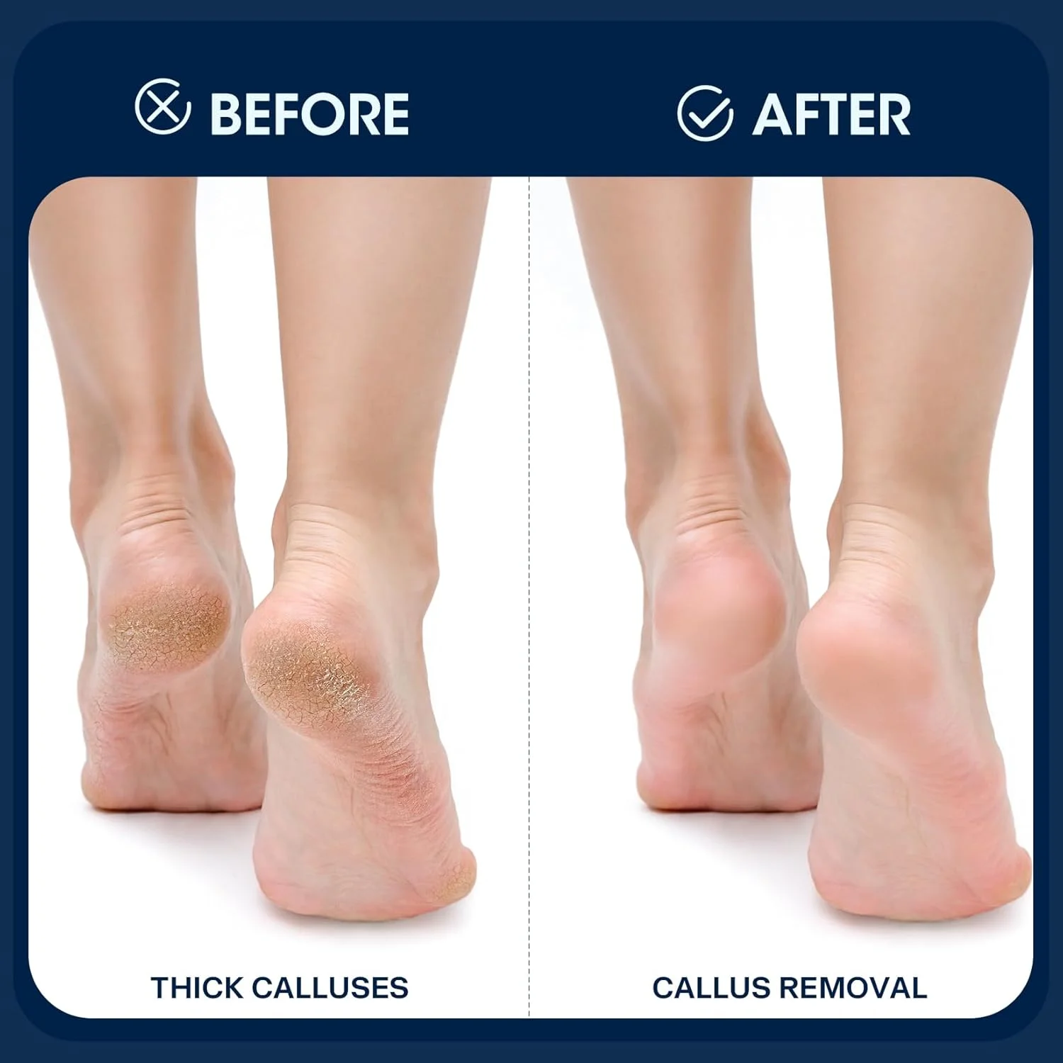 سوهان برقی پینه پا تودو، ابزار پدیکور برقی قابل تنظیم سرعت، ضد آب و قابل شارژ برای از بین بردن پوست مرده پا (مشکی) سوهان برقی پینه پا تودو، ابزار پدیکور برقی قابل تنظیم سرعت، ضد آب و قابل شارژ برای از بین بردن پوست مرده پا (مشکی)