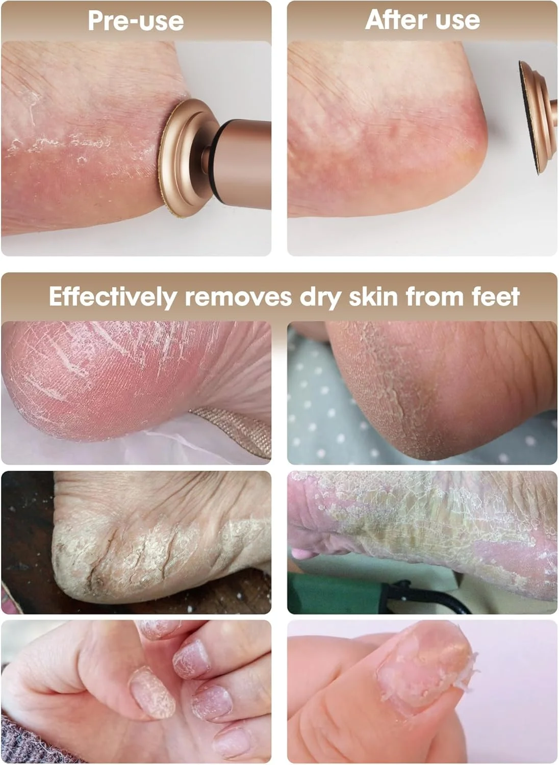 سوهان برقی پدیکور کیوسید - 2 در 1، سوهان برقی بی سیم پا و دستگاه سنگ پا، از بین برنده پینه پا با 3 حالت، از بین برنده پوست خشک پا (رزگلد)