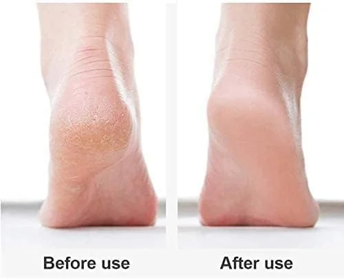 سوهان برقی پا از بین برنده پینه، پاهایی نرم و لطیف در عرض چند دقیقه سوهان برقی پا از بین برنده پینه، پاهایی نرم و لطیف در عرض چند دقیقه