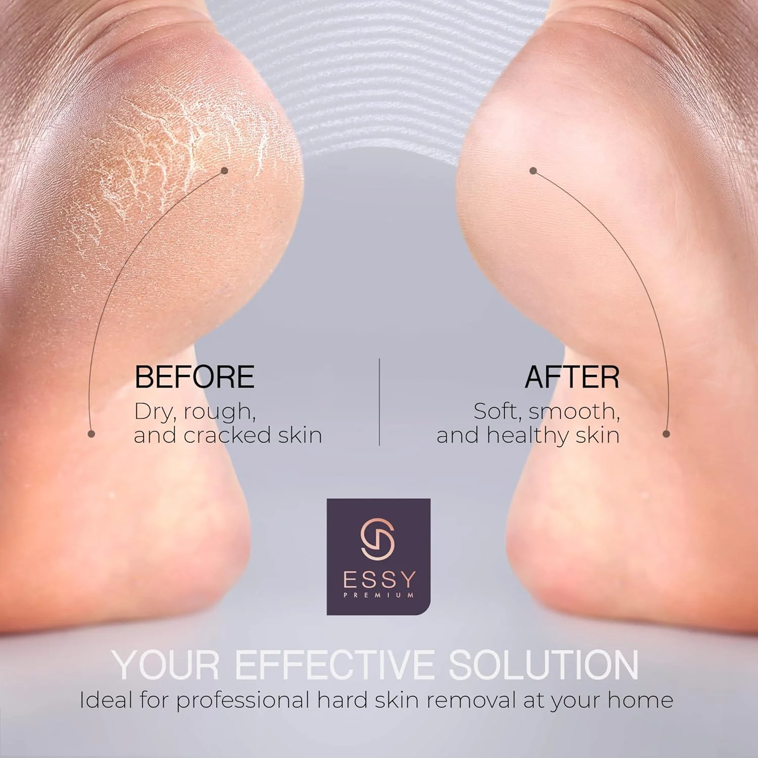 سوهان برقی پا Essy، از بین برنده پینه پا، سوهان برقی پا برای از بین بردن پوست مرده، ابزار از بین برنده پینه پا، پدیکور برقی، کیت سوهان برقی پا