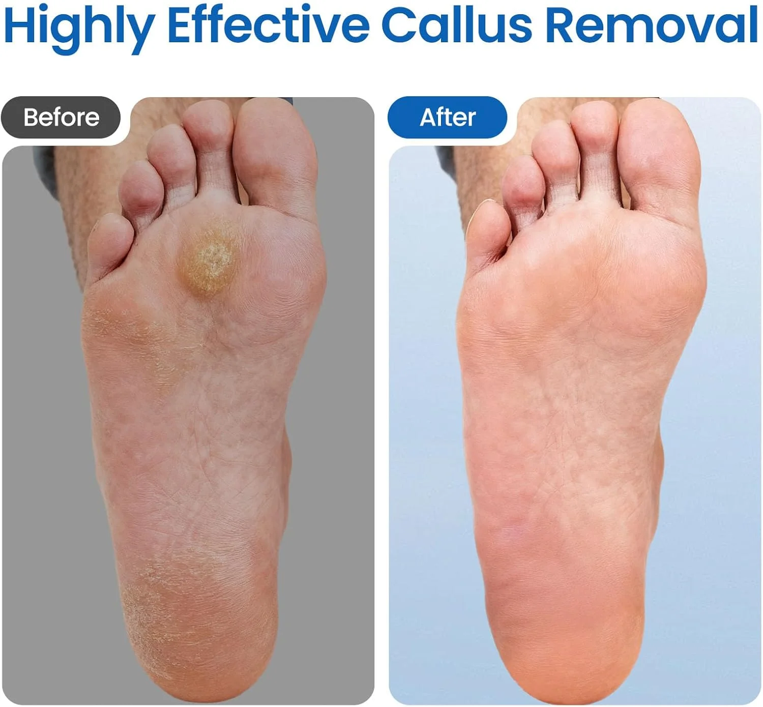 سوهان برقی پدیکور پا - سوهان برقی پا با سرعت قابل تنظیم به همراه 60 عدد دیسک سمباده ای مناسب برای از بین بردن پینه، پوست های مرده و ترک پاشنه آقایان و بانوان، ابزار حرفه ای پدیکور