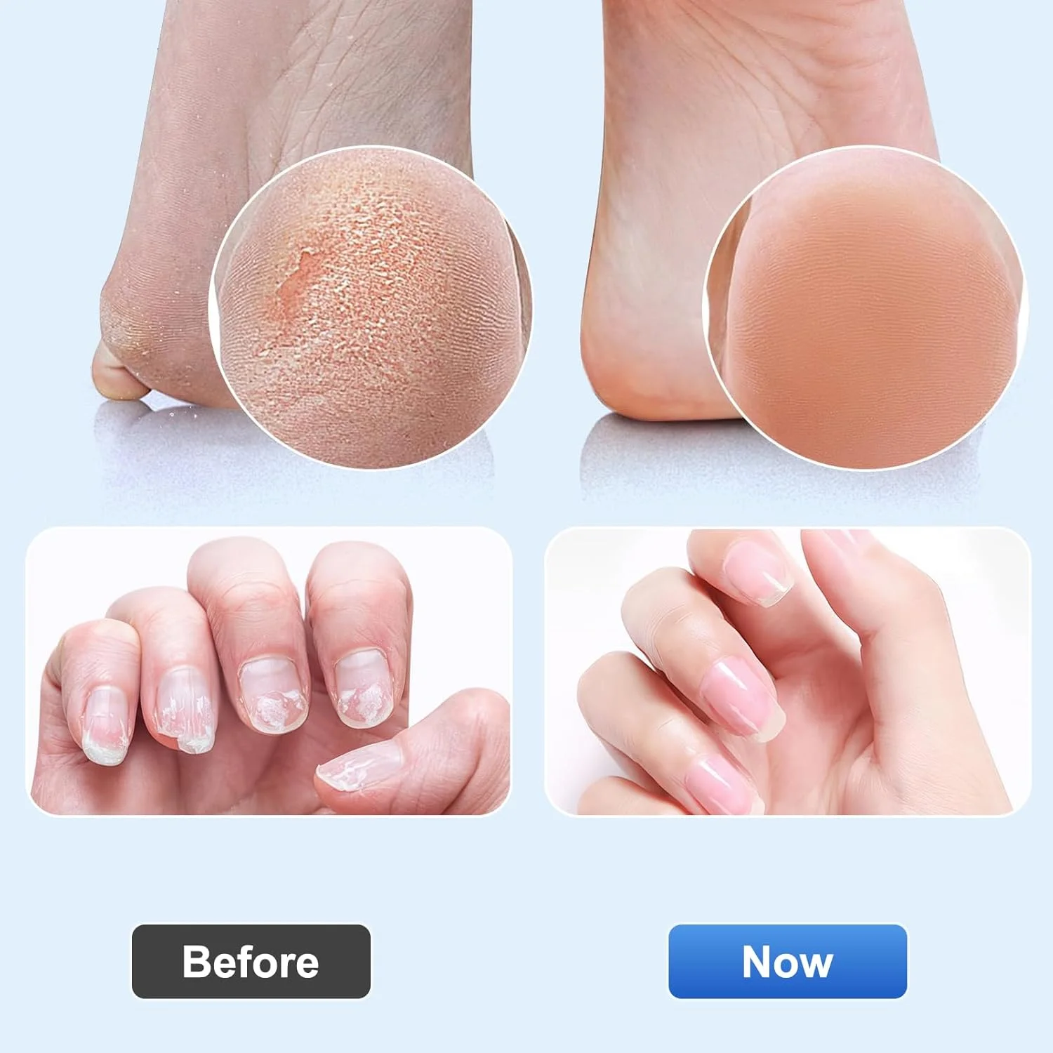 سوهان برقی پینه پا 2 در 1، سوهان برقی پینه پا با 20 عدد کاغذ سنباده و 10 حلقه یخی، سوهان برقی پا برای پوست های مرده و ترک خورده سوهان برقی پینه پا 2 در 1، سوهان برقی پینه پا با 20 عدد کاغذ سنباده و 10 حلقه یخی، سوهان برقی پا برای پوست های مرده و ترک خورده