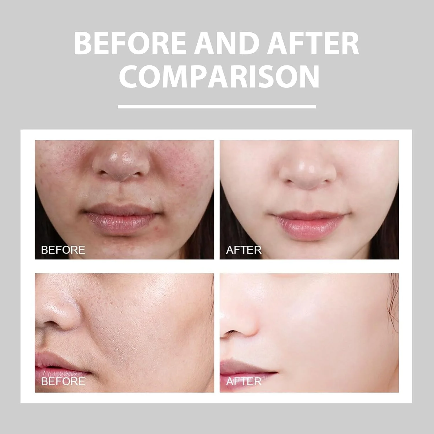 کرم ضد جوش آزونی، کرم های مرطوب کننده صورت برای پوست مستعد آکنه، کرم صورت کنترل کننده آکنه با اسید هیالورونیک، کرم های از بین برنده آکنه برای آبرسانی، مراقبت از پوست برای پوست حساس کرم ضد جوش آزونی، کرم های مرطوب کننده صورت برای پوست مستعد آکنه، کرم صورت کنترل کننده آکنه با اسید هیالورونیک، کرم های از بین برنده آکنه برای آبرسانی، مراقبت از پوست برای پوست حساس