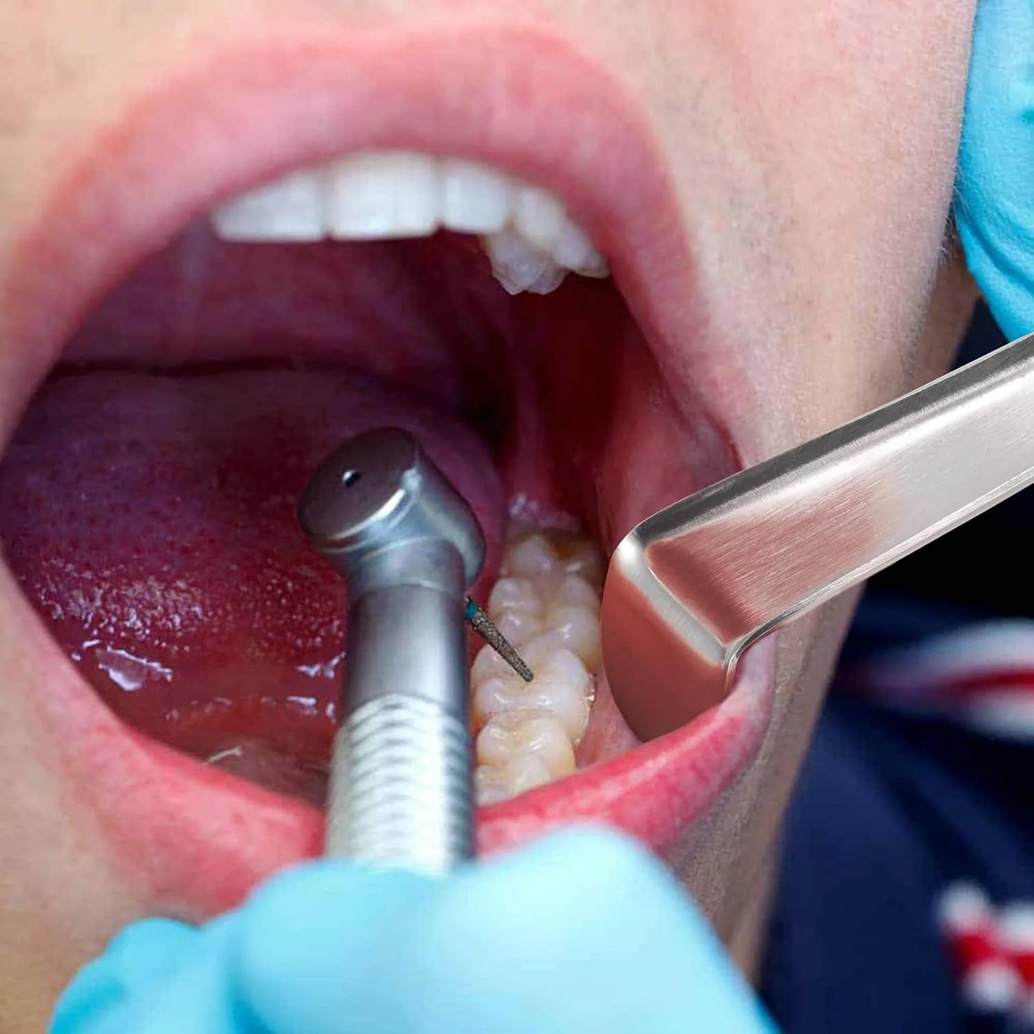 3 عدد رترکتور گونه دندانپزشکی مینه سوتا، بازکننده دهان روکش طلا، ابزار دندانپزشکی استیل ضد زنگ مورد استفاده در کلینیک دندانپزشکی - مستقیم 3 عدد رترکتور گونه دندانپزشکی مینه سوتا، بازکننده دهان روکش طلا، ابزار دندانپزشکی استیل ضد زنگ مورد استفاده در کلینیک دندانپزشکی - مستقیم