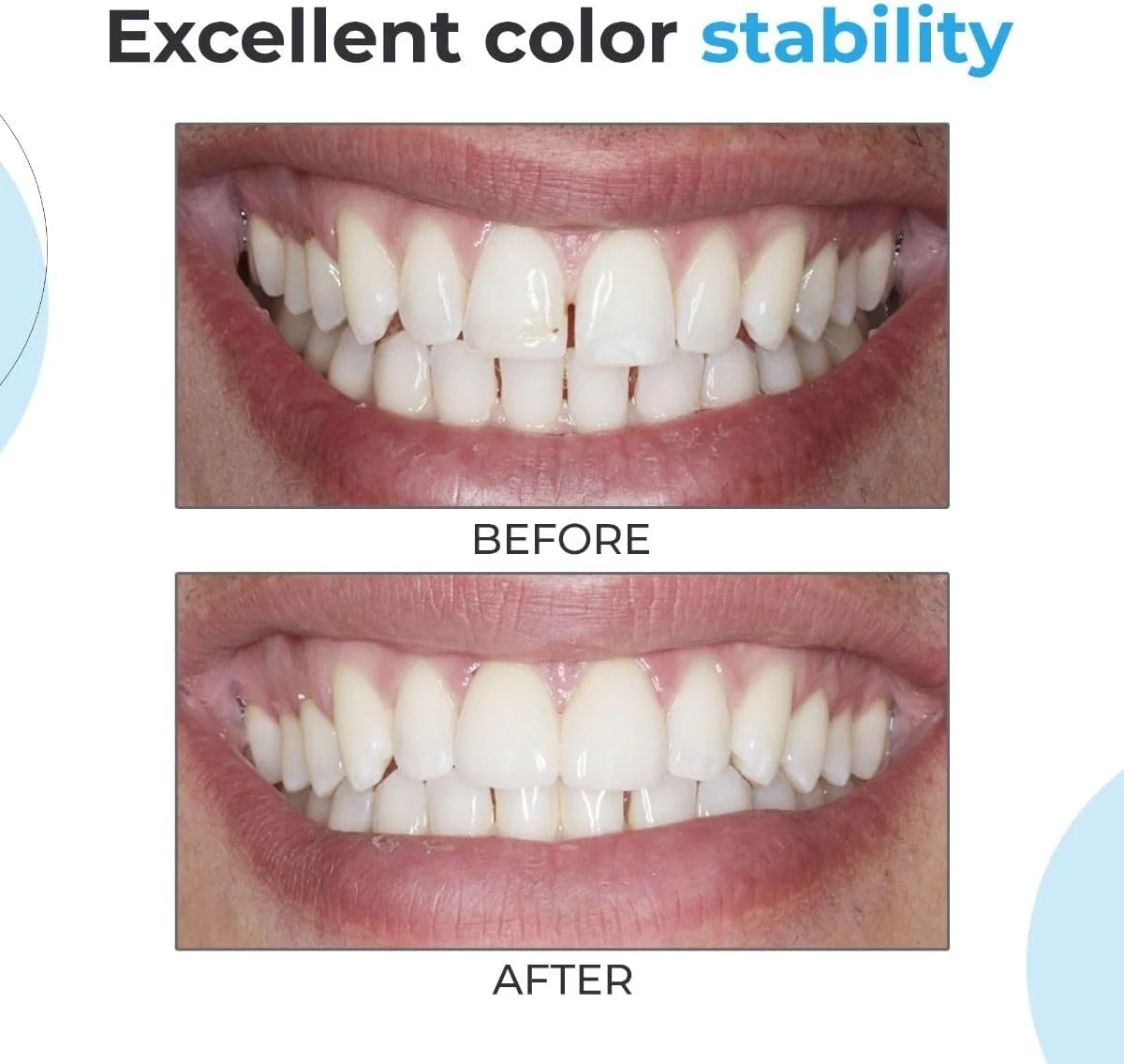 کیت کامپوزیت زیرکونیوم نانو فیل والدنت کیت کامپوزیت زیرکونیوم نانو فیل والدنت