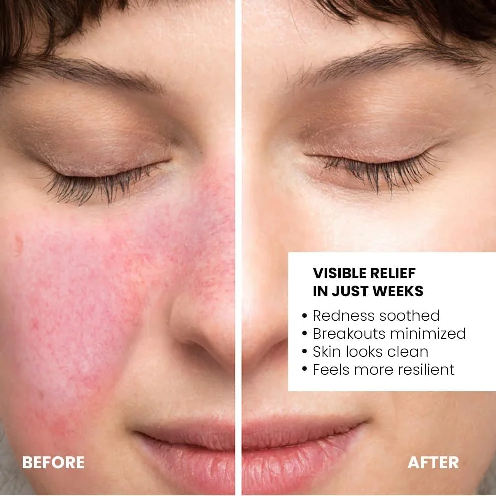 سرم صورت حاوی 10% آزلائیک اسید The True Therapy به همراه عصاره فندق افسونگر، ضد التهاب، آکنه کیستی، رزاسه، هایپرپیگمنتیشن، کاهش قرمزی، چربی اضافی و جوش - 30 میلی لیتر سرم صورت حاوی 10% آزلائیک اسید The True Therapy به همراه عصاره فندق افسونگر، ضد التهاب، آکنه کیستی، رزاسه، هایپرپیگمنتیشن، کاهش قرمزی، چربی اضافی و جوش - 30 میلی لیتر