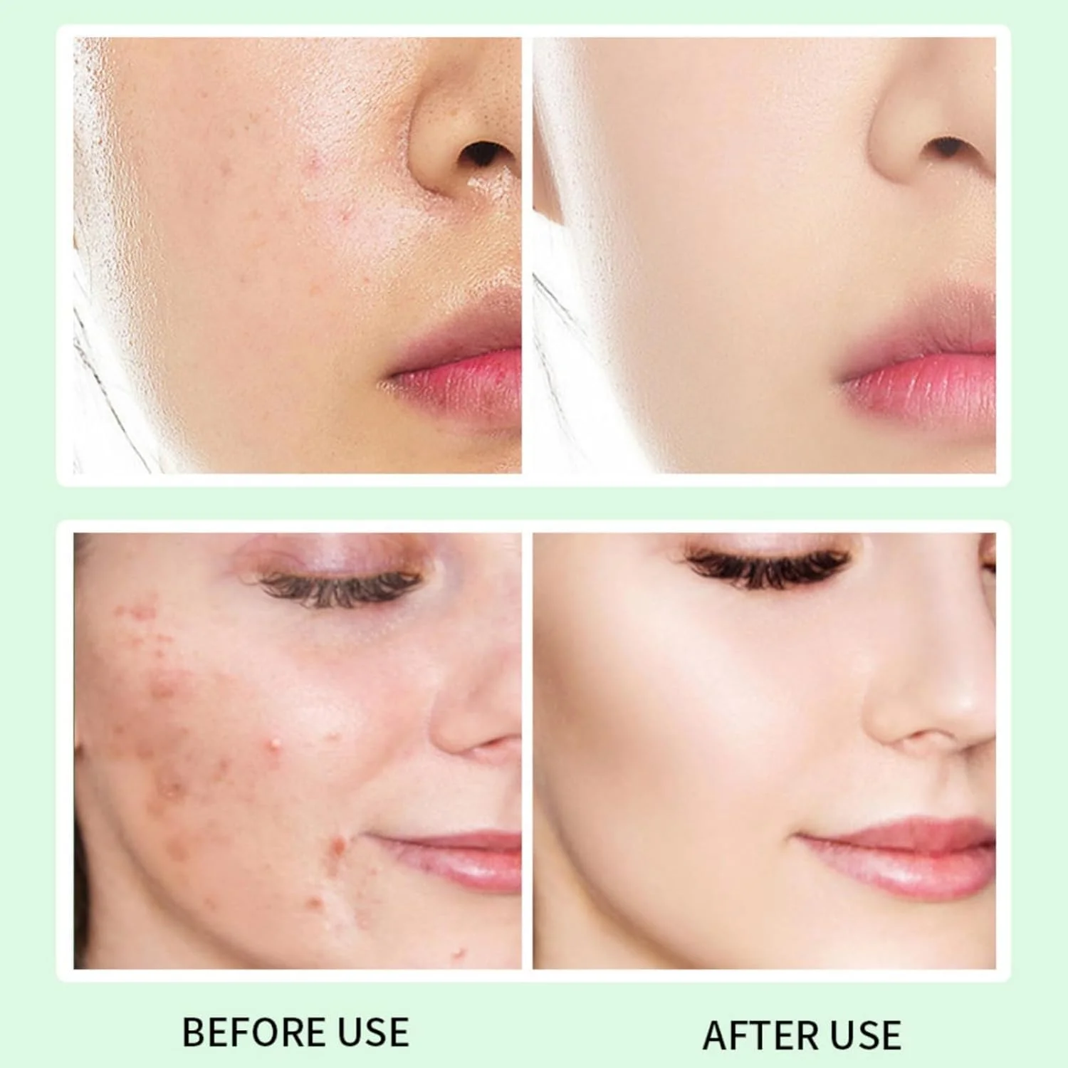 کرم صورت حاوی 14% آزلائیک اسید FUIN، کرم سرم همراه با نیاسینامید و ویتامین C، ضد قرمزی، کاهش لک، آکنه و روزاسه، کوچک کننده منافذ، مناسب برای انواع پوست