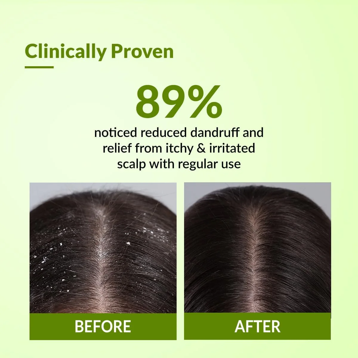 شامپو ضد شوره فیکسرما Kairfoll برای پوست سر چرب و حساس مستعد شوره و فولیکولیت | شامپو ضد شوره برای زنان و مردان | اسید سالیسیلیک برای ریزش مو | شامپو بدون سولفات - 100 میلی لیتر شامپو ضد شوره فیکسرما Kairfoll برای پوست سر چرب و حساس مستعد شوره و فولیکولیت | شامپو ضد شوره برای زنان و مردان | اسید سالیسیلیک برای ریزش مو | شامپو بدون سولفات - 100 میلی لیتر