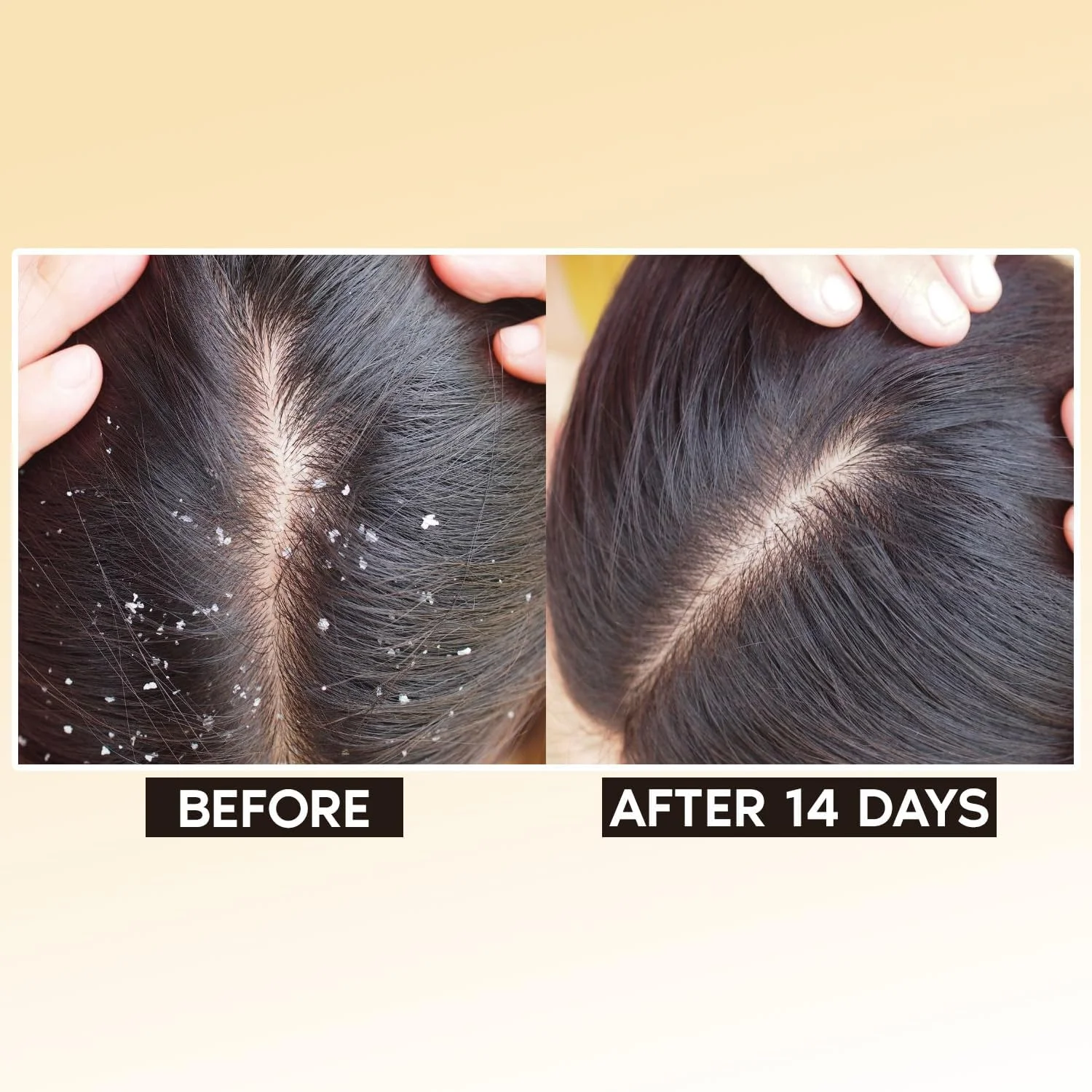 شامپو ضد شوره سر کاسومو به همراه هدیه ماساژور پوست سر | کاهش ریزش مو و شامپو ضد شوره برای پوست سر خشک، خارش دار و پوسته پوسته | شامپو درمان طبیعی ضد ریزش مو بدون سولفات (250 میلی لیتر) شامپو ضد شوره سر کاسومو به همراه هدیه ماساژور پوست سر | کاهش ریزش مو و شامپو ضد شوره برای پوست سر خشک، خارش دار و پوسته پوسته | شامپو درمان طبیعی ضد ریزش مو بدون سولفات (250 میلی لیتر)