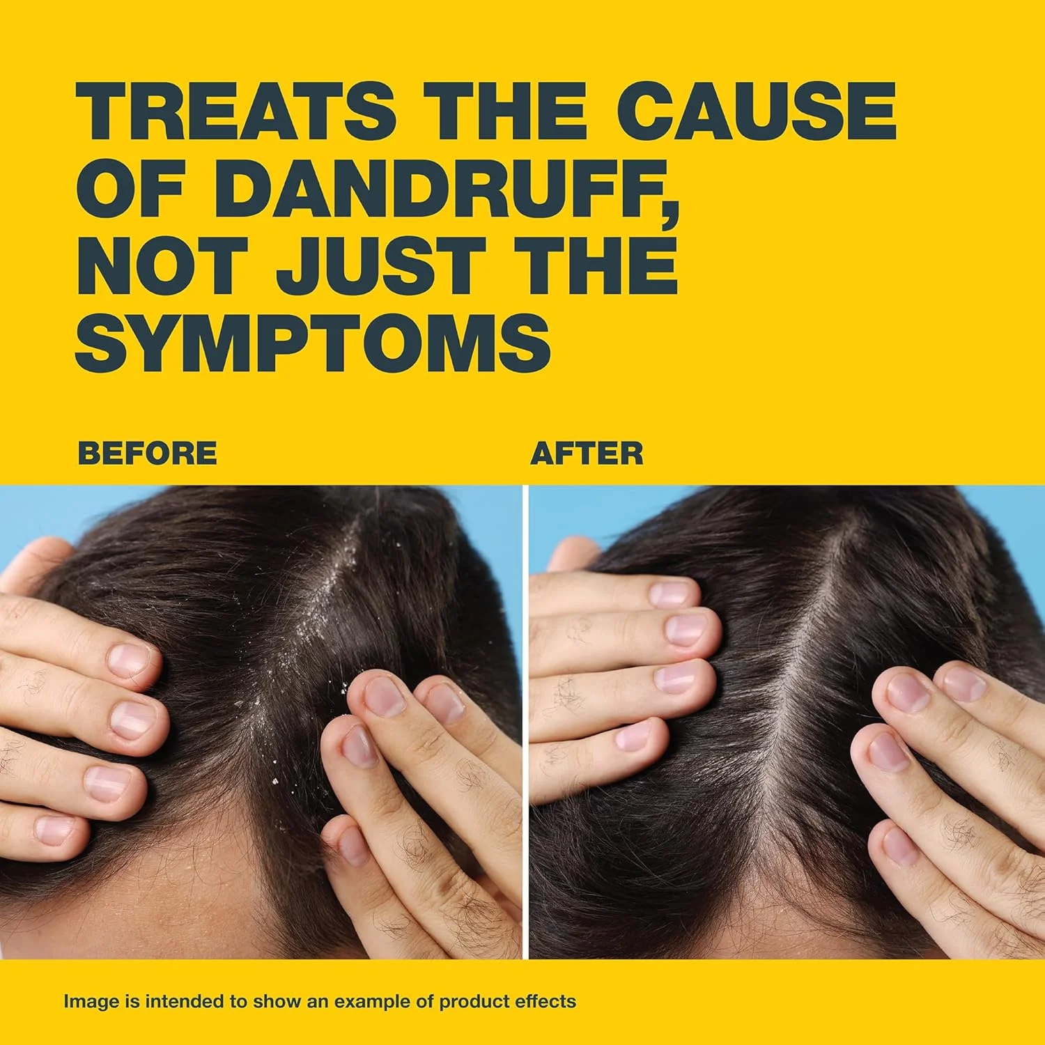 شامپو ضد شوره نیزورال 2%، 100 میلی لیتر، درمان پزشکی با کتوکونازول، از نظر بالینی ثابت شده برای درمان شوره سر، پوسته پوسته شدن و خارش