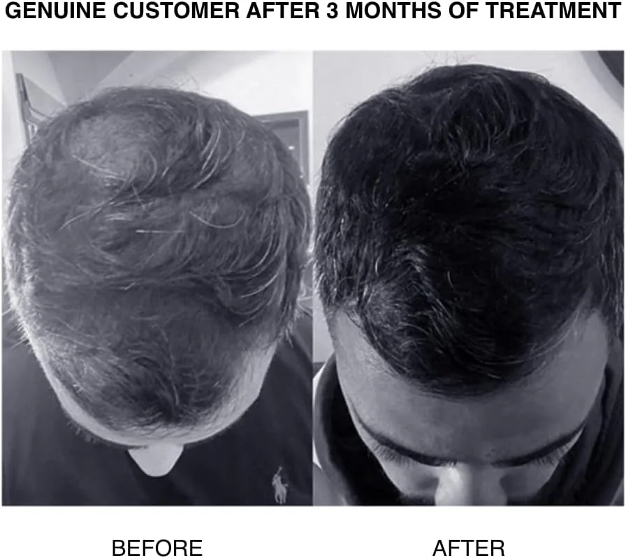 پاتریکس | شامپو فوق غلیظ کننده SH PLUS برای ریزش مو در مردان | مسدود کننده DHT | حاوی روغن کرچک و سایر مواد قدرتمند برای حمایت از رشد مو | برای ریزش مو متوسط تا پیشرفته | 200 میلی لیتر پاتریکس | شامپو فوق غلیظ کننده SH PLUS برای ریزش مو در مردان | مسدود کننده DHT | حاوی روغن کرچک و سایر مواد قدرتمند برای حمایت از رشد مو | برای ریزش مو متوسط تا پیشرفته | 200 میلی لیتر