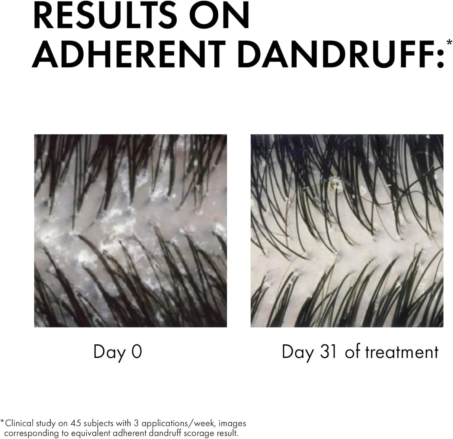 شامپو ضد شوره موهای معمولی تا چرب ویشی درکوس 200 میلی لیتر شامپو ضد شوره موهای معمولی تا چرب ویشی درکوس 200 میلی لیتر