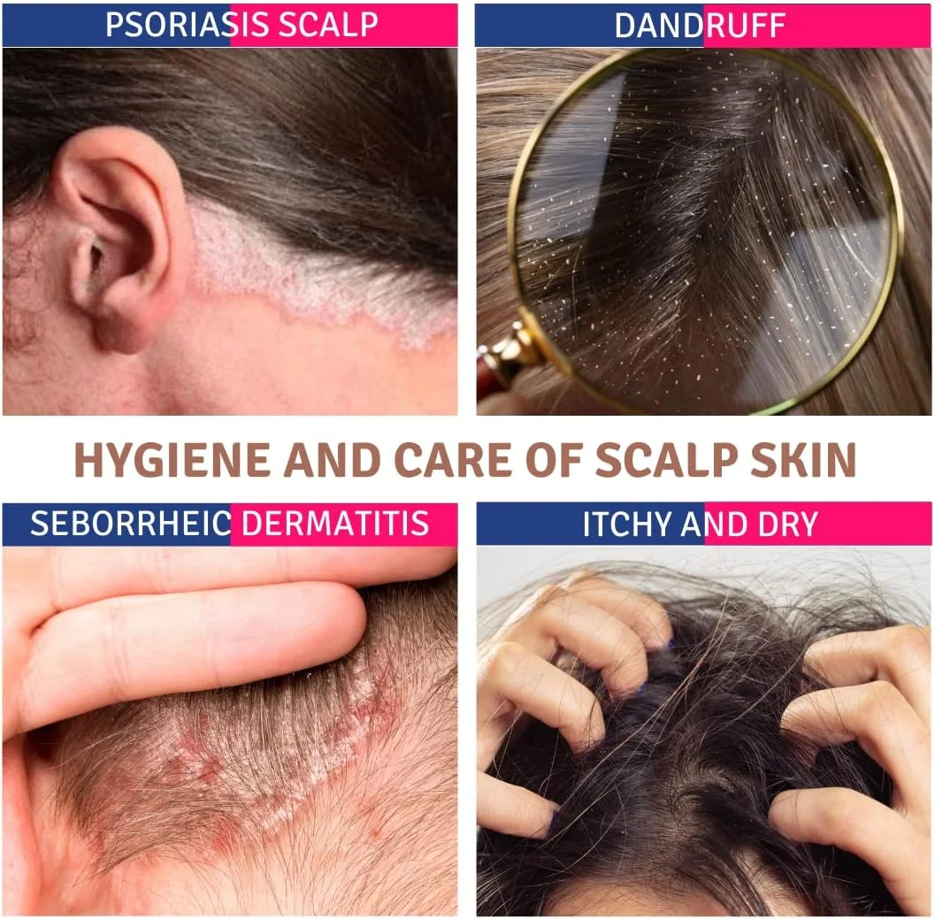 شامپو اوره 10% پسوریتیس - مناسب پوست سر مستعد پسوریازیس و سبوره | درماتیت سبورئیک، شوره سر، پیتریازیس، ایکتیوزیس | پوست ملتهب، پوسته پوسته و خارش دار | روغن جوانه گندم - 120 میلی لیتر