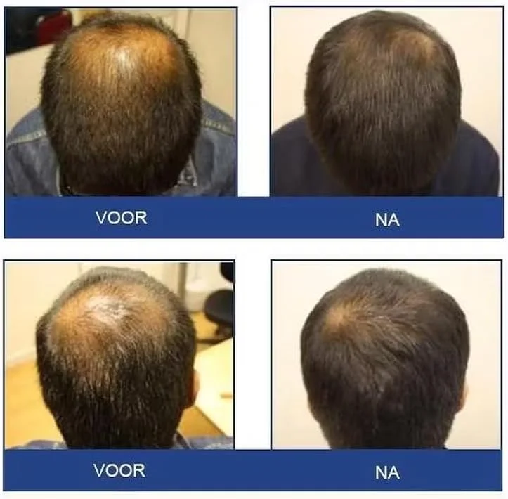 شامپو محرک فولیکین برای موهای نازک - مخصوص آقایان 236 میلی لیتر