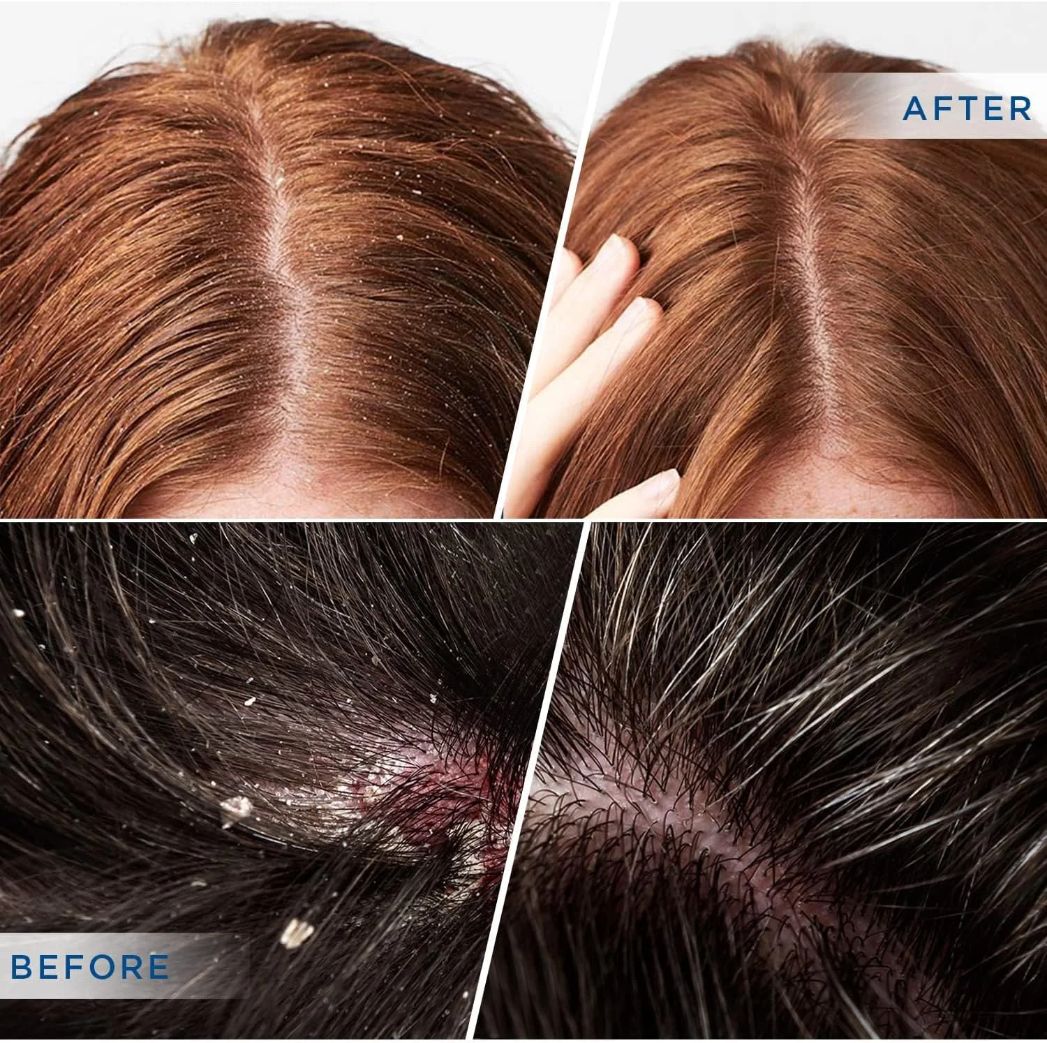 شامپو پسوریازیس Derphea: درماتیت سبورئیک، فولیکولیت - برای اگزما، شوره سر، خارش و خشکی پوست سر - مواد ایمن برای انواع پوست شامپو پسوریازیس Derphea: درماتیت سبورئیک، فولیکولیت - برای اگزما، شوره سر، خارش و خشکی پوست سر - مواد ایمن برای انواع پوست