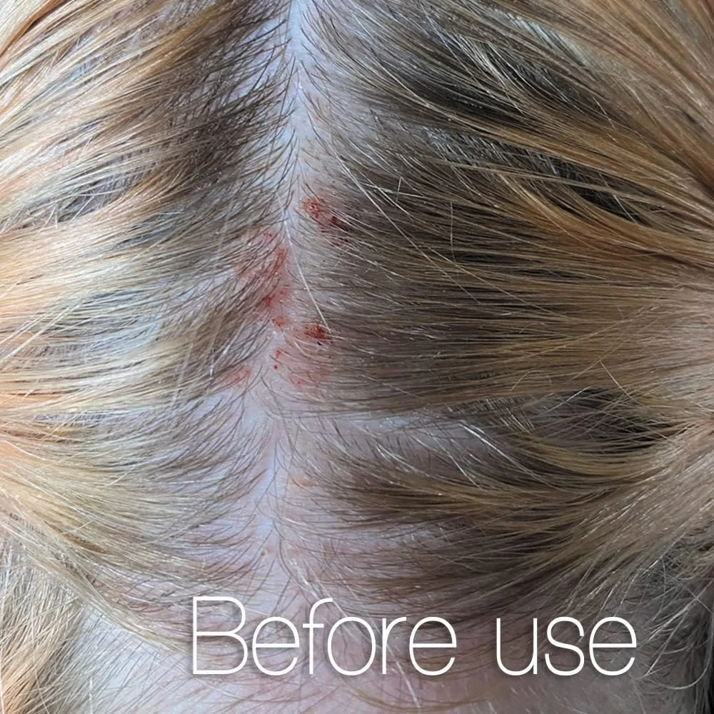 HAIRCALMA - شامپو ضد شوره، ضد حساسیت، با کف کم. مناسب برای پوست سر خشک/تحریک شده، حساس، دارای خارش/پوسته پوسته، و چرب. بطری 400 میلی لیتری.