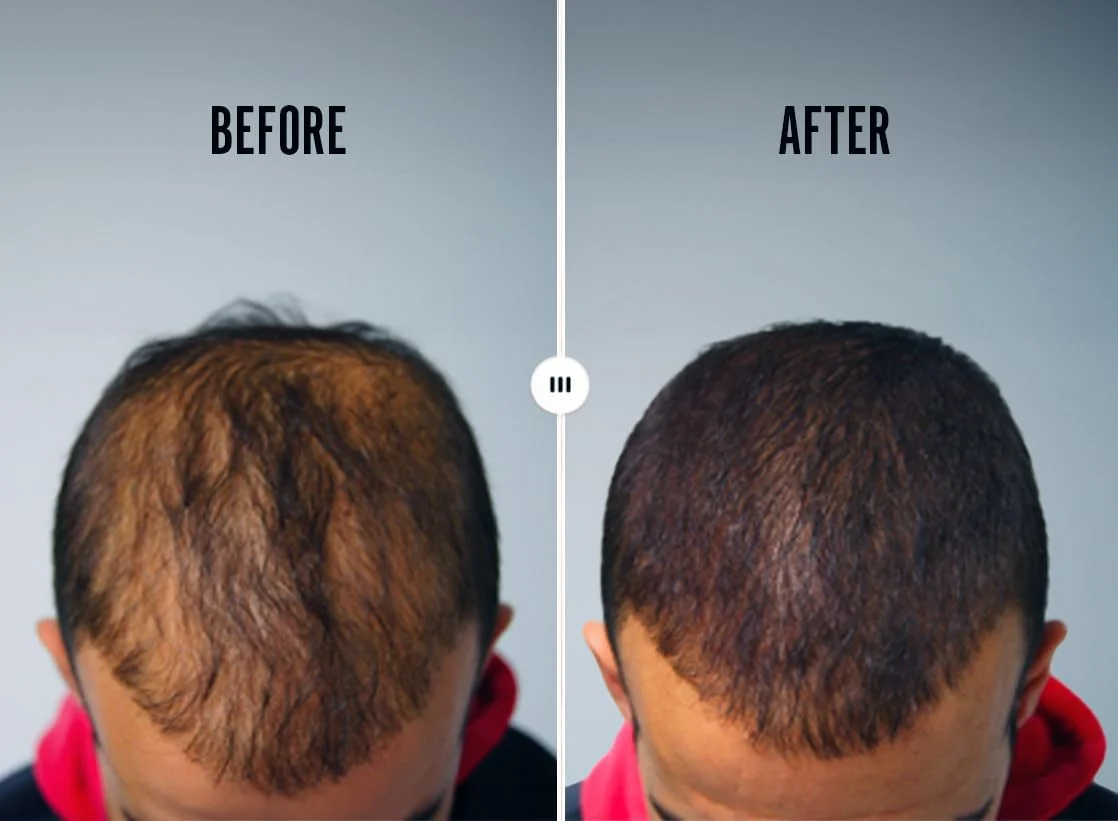 مجموعه شامپو پاک کننده زیستی و محلول درمان پوست سر Revivogen MD برای موهای نازک مجموعه شامپو پاک کننده زیستی و محلول درمان پوست سر Revivogen MD برای موهای نازک