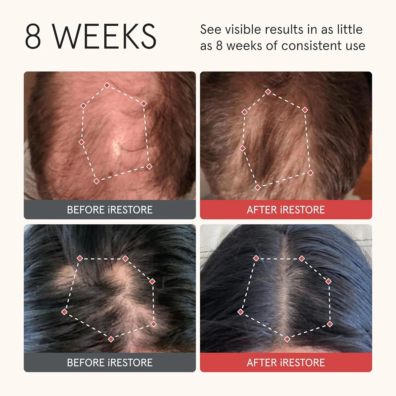 نرم کننده مو بیوتین iRestore برای موهای خشک و آسیب دیده - نرم کننده بیوتین برای رشد موهای نازک، نرم کننده حجم دهنده و ضخیم کننده با جینسینگ و روغن آرگان برای مرطوب کردن، همراه با شامپو ضد ریزش مو نرم کننده مو بیوتین iRestore برای موهای خشک و آسیب دیده - نرم کننده بیوتین برای رشد موهای نازک، نرم کننده حجم دهنده و ضخیم کننده با جینسینگ و روغن آرگان برای مرطوب کردن، همراه با شامپو ضد ریزش مو