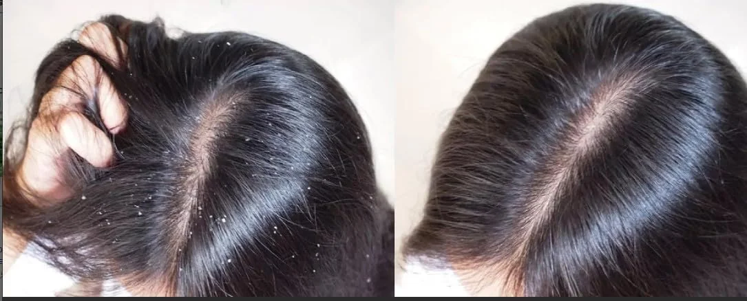 بهترین شامپو ضد شوره و ضد چربی - 1000 میلی لیتر | درمان حرفه ای شوره سر و کنترل چربی | فرمول تسکین دهنده برای پوست سر خارش دار، پوسته پوسته و چرب بهترین شامپو ضد شوره و ضد چربی - 1000 میلی لیتر | درمان حرفه ای شوره سر و کنترل چربی | فرمول تسکین دهنده برای پوست سر خارش دار، پوسته پوسته و چرب