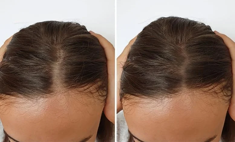 بهترین شامپو ضد شوره و ضد چربی مو – 250 میلی لیتر | درمان شوره سر و کنترل چربی پوست سر | فرمول تسکین دهنده برای پوست سر خارش دار، پوسته پوسته و چرب بهترین شامپو ضد شوره و ضد چربی مو – 250 میلی لیتر | درمان شوره سر و کنترل چربی پوست سر | فرمول تسکین دهنده برای پوست سر خارش دار، پوسته پوسته و چرب