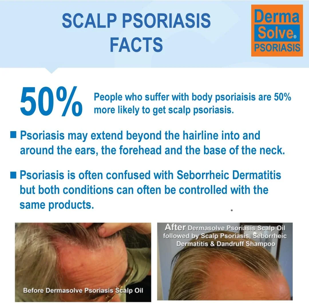 شامپو و نرم کننده دارویی پسوریازیس سر Dermasolve - التیام طبیعی شوره سر، درماتیت سبورئیک، خارش، پوسته پوسته شدن، التهاب پوست و تسکین دهنده و مرطوب کننده - بطری های 236 میلی لیتری (2 عددی) شامپو و نرم کننده دارویی پسوریازیس سر Dermasolve - التیام طبیعی شوره سر، درماتیت سبورئیک، خارش، پوسته پوسته شدن، التهاب پوست و تسکین دهنده و مرطوب کننده - بطری های 236 میلی لیتری (2 عددی)