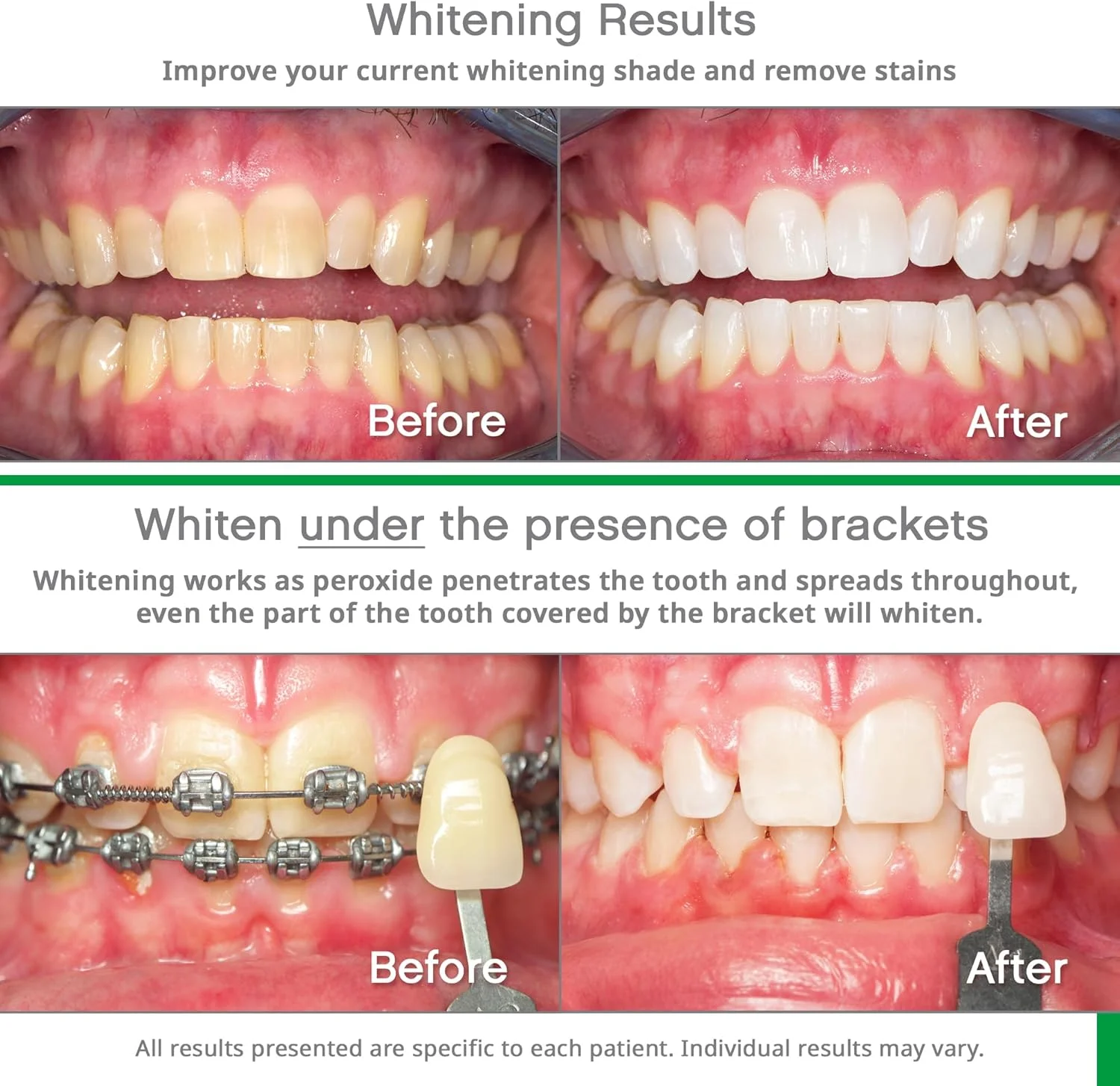 مجموعه سفید کننده Opalescence - سینی های سفید کننده از پیش پر شده Opalescence Go با 15% هیدروژن پراکسید و خمیر دندان سفید کننده - طعم نعناع 5194-5166