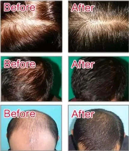 لوسیون ضد ریزش مو دکسی 6 میلی لیتر * 10