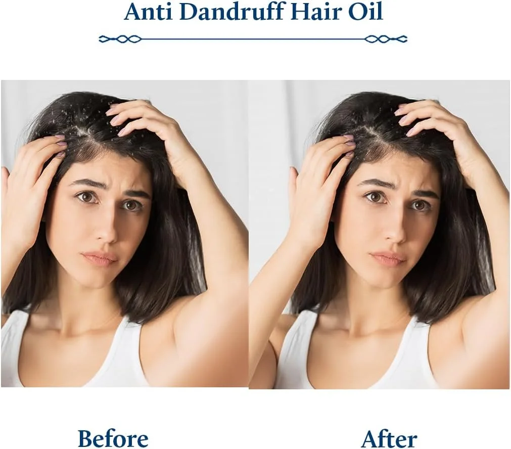 روغن مو ضد شوره سر بلو نکتار با عصاره چریش و درخت چای | روغن موی غیر چسبنده آیورودا برای پوست سر خشک و شوره سر | گیاهی برای آقایان و بانوان (12 گیاه، 100 میلی لیتر) روغن مو ضد شوره سر بلو نکتار با عصاره چریش و درخت چای | روغن موی غیر چسبنده آیورودا برای پوست سر خشک و شوره سر | گیاهی برای آقایان و بانوان (12 گیاه، 100 میلی لیتر)