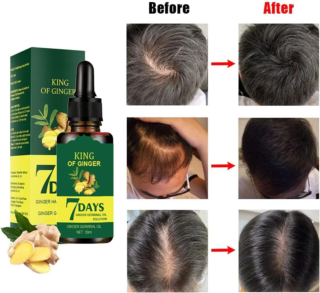 روغن جوانه زنجبیل برای رشد مو 1DFAUL، سرم جوانه زنجبیل برای تغذیه ریشه مو، 30 میلی لیتر (3 عدد) روغن جوانه زنجبیل برای رشد مو 1DFAUL، سرم جوانه زنجبیل برای تغذیه ریشه مو، 30 میلی لیتر (3 عدد)