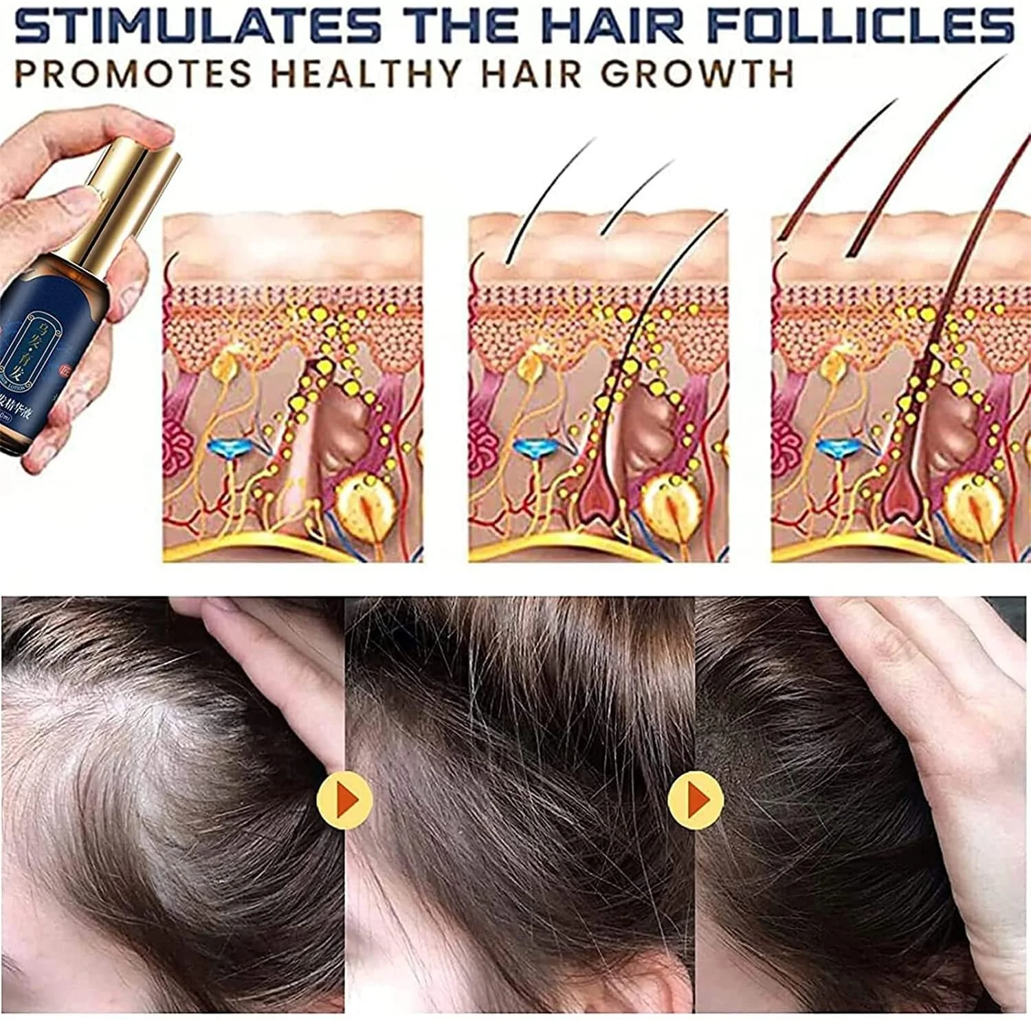 اسپری تقویت کننده مو ZOKU-HGP، سرم رشد مو Polygonum Multiflorums، افزایش تراکم مو، روغن های ضروری رشد مو عصاره زنجبیل برای مردان و زنان (1 عدد)