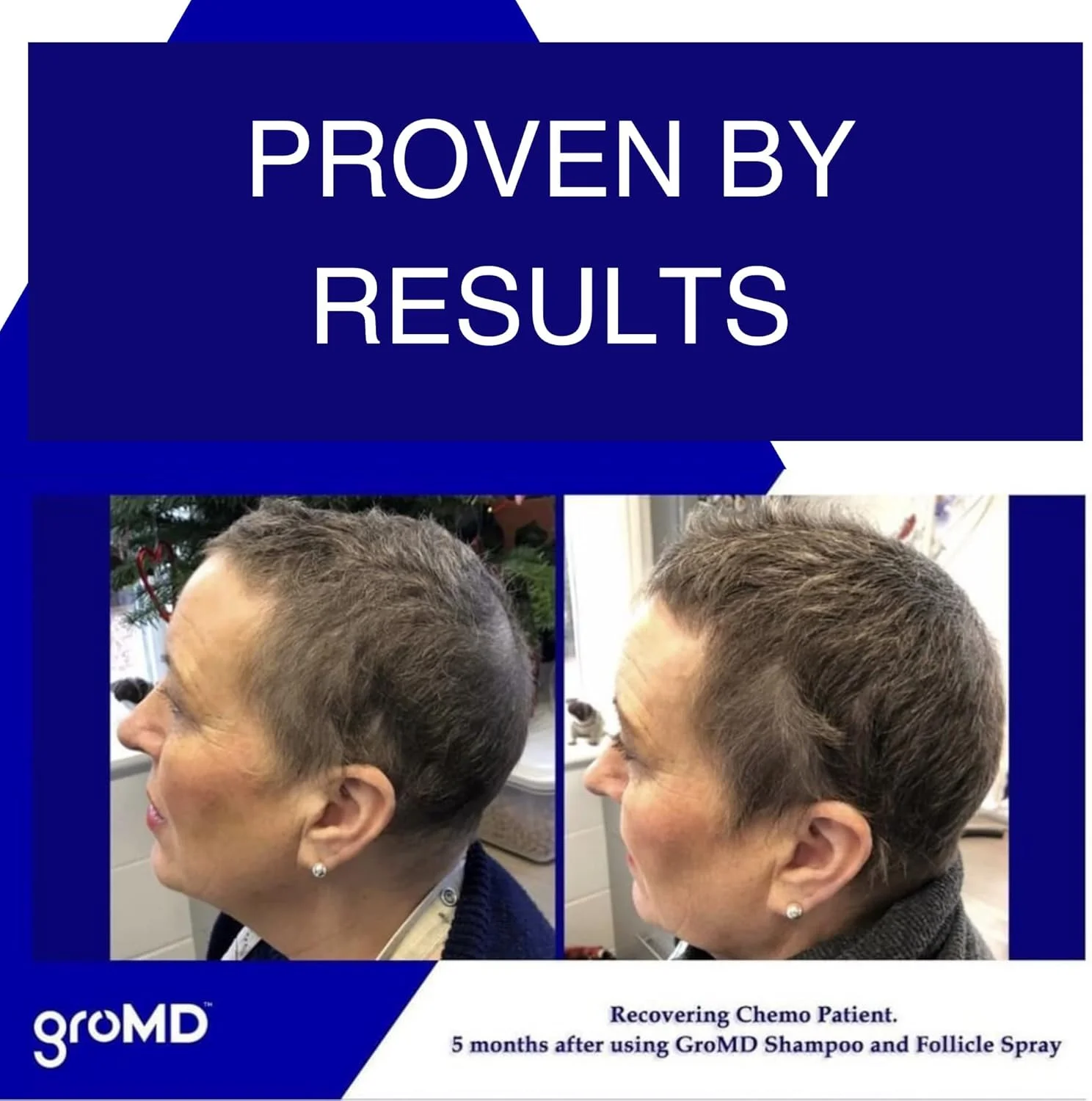 سرم ضد ریزش مو GroMD، درمان رشد مو، رشد مجدد، اسپری فعال کننده فولیکول، روغن آرگان، بیوتین و کافئین، ضخیم کننده، ساخته شده توسط پزشک، مواد مسدود کننده DHT، 60 روزه سرم ضد ریزش مو GroMD، درمان رشد مو، رشد مجدد، اسپری فعال کننده فولیکول، روغن آرگان، بیوتین و کافئین، ضخیم کننده، ساخته شده توسط پزشک، مواد مسدود کننده DHT، 60 روزه