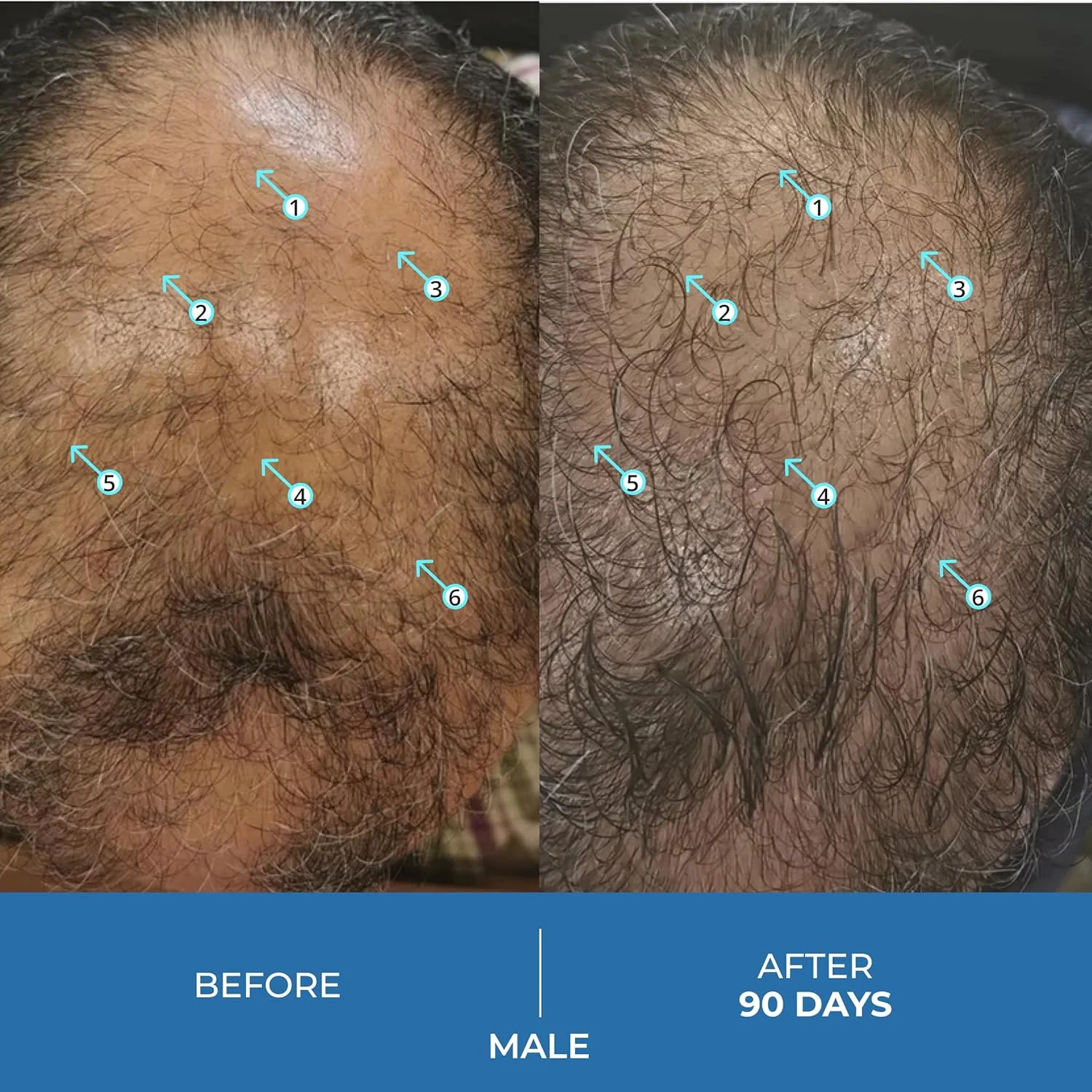 سرم افزایش تراکم موی آقایان DS Labs Spectral.UHP حاوی 5% ماینوکسیدیل - فرمول موضعی با قدرت فوق العاده برای موهایی با ظاهر ضخیم تر، هدف قرار دادن نازک شدن در ناحیه تاج سر، با فناوری نانوزوم، 60 میلی لیتر (بسته 3 عددی) سرم افزایش تراکم موی آقایان DS Labs Spectral.UHP حاوی 5% ماینوکسیدیل - فرمول موضعی با قدرت فوق العاده برای موهایی با ظاهر ضخیم تر، هدف قرار دادن نازک شدن در ناحیه تاج سر، با فناوری نانوزوم، 60 میلی لیتر (بسته 3 عددی)